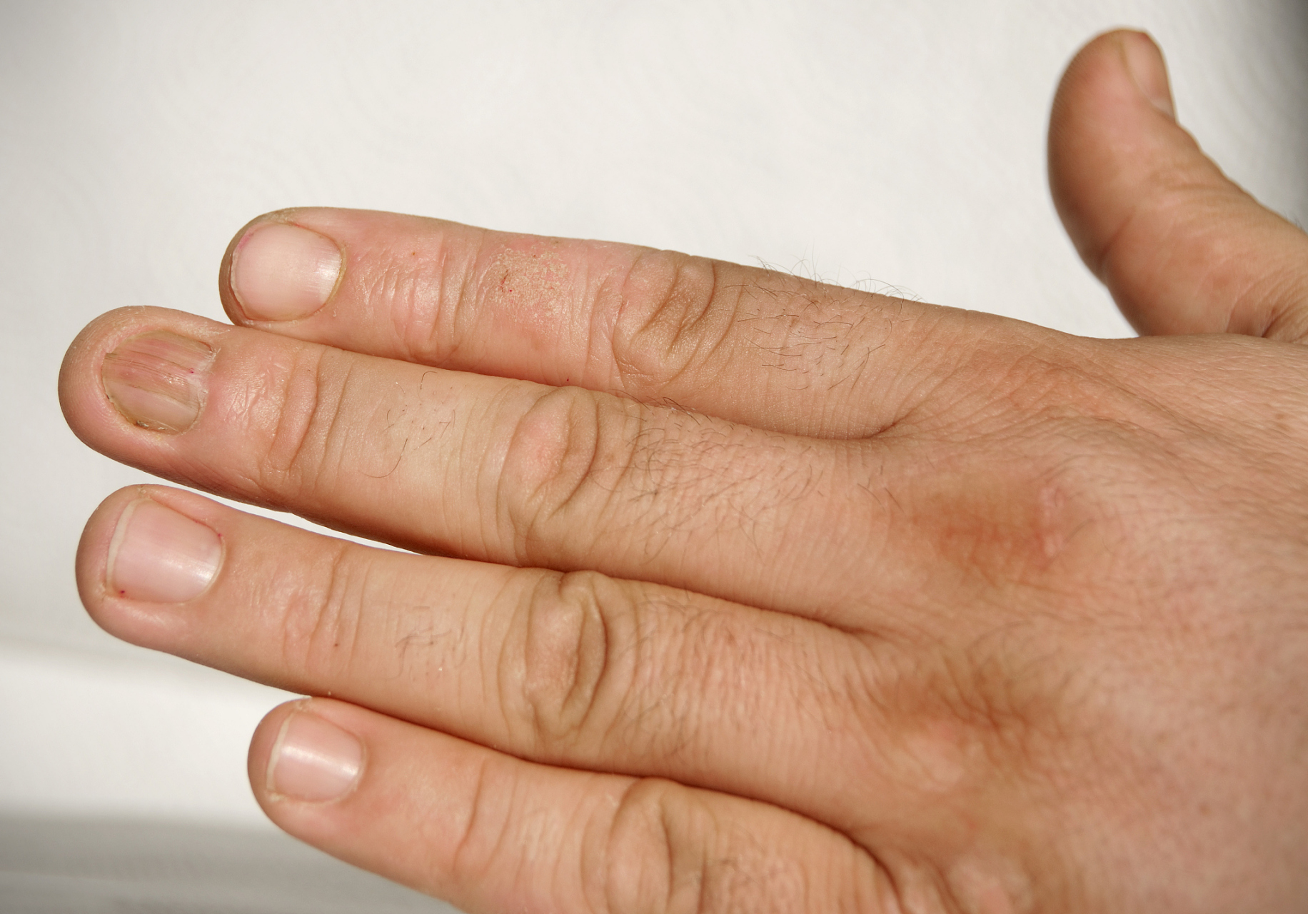 鹅掌风,是民间中医对于手癣的一种叫法,是由于真菌引发的皮肤类疾病