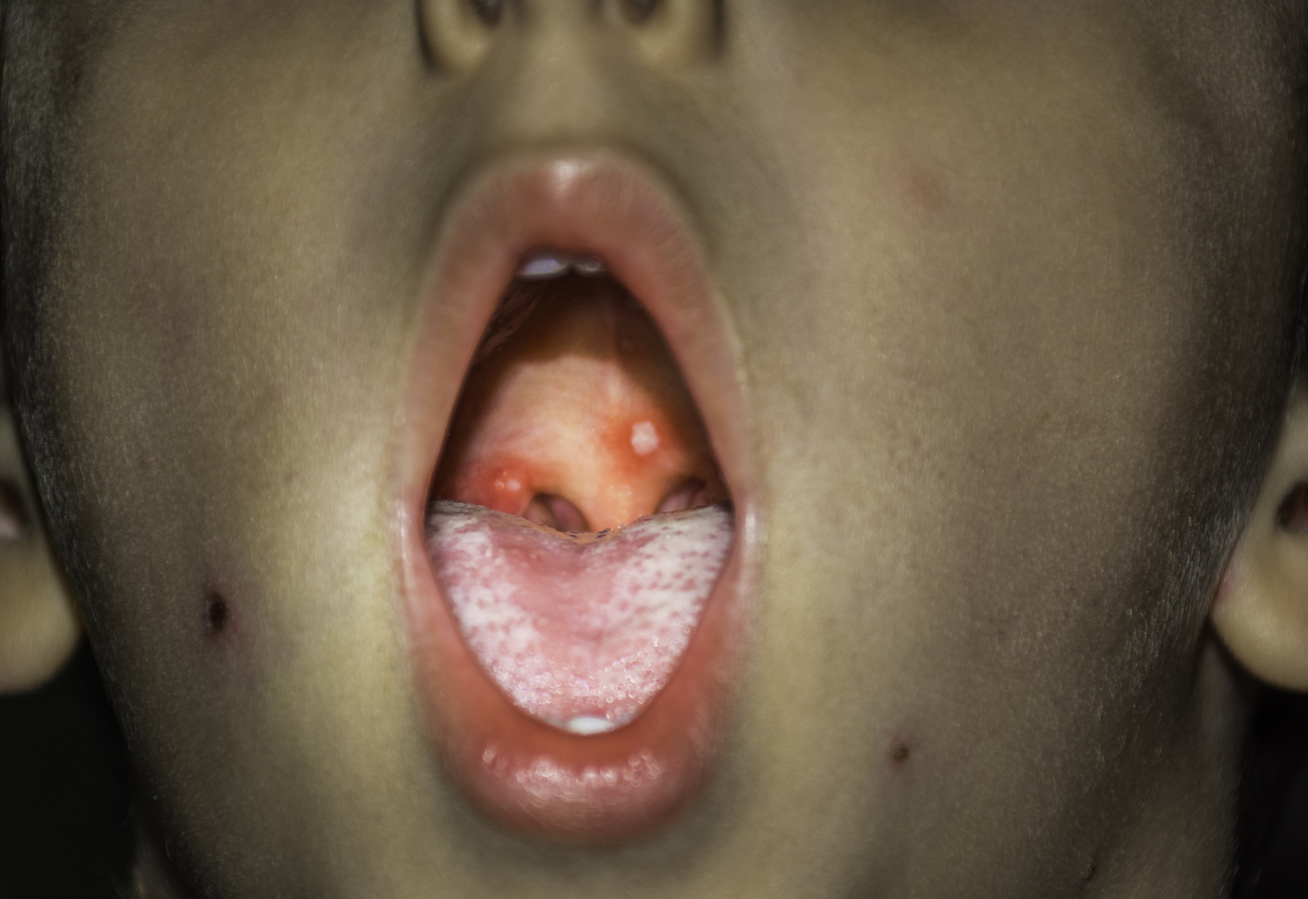 春季常扁桃体发炎,这⑦个症状要重视  春季是流感高发的季节,但也是易