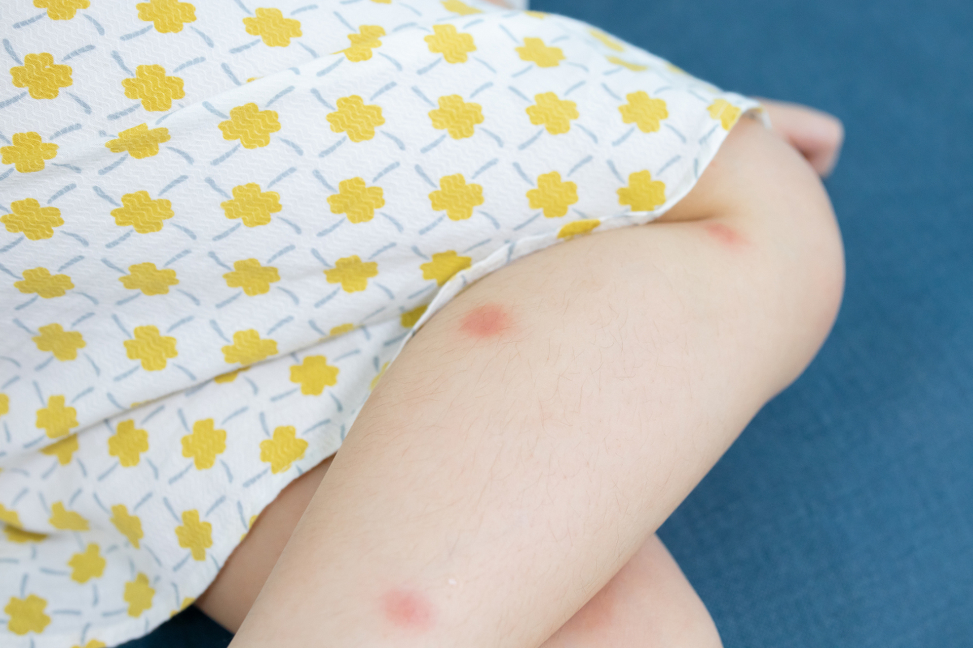 血管痣是婴儿常见的一种良性肿瘤,主要是由胚胎期血管网增生所谐缮