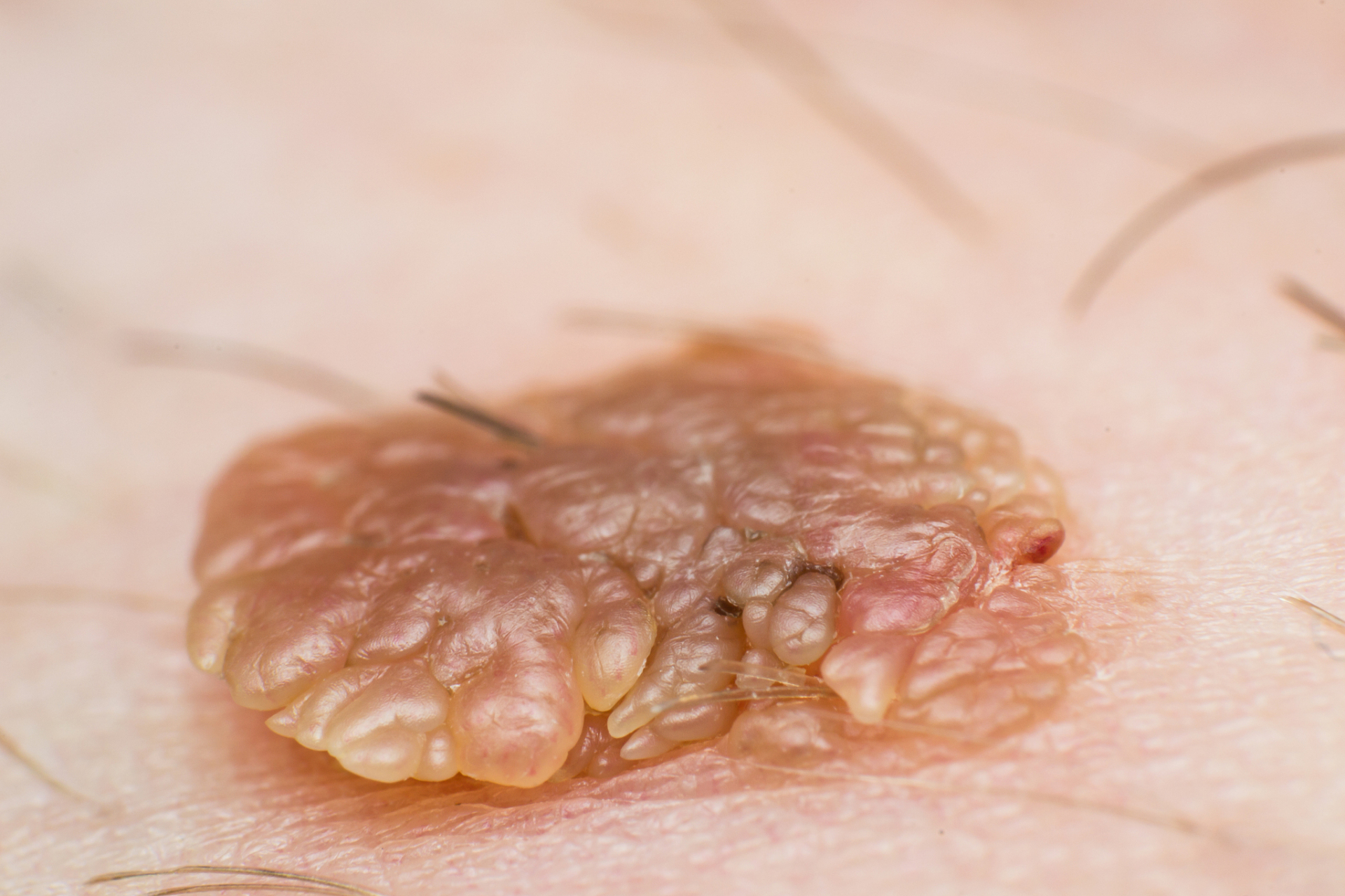 女人感染hpv,皮肤3处很明显,别以为是过敏了 1,脖子长条状疙瘩 感染