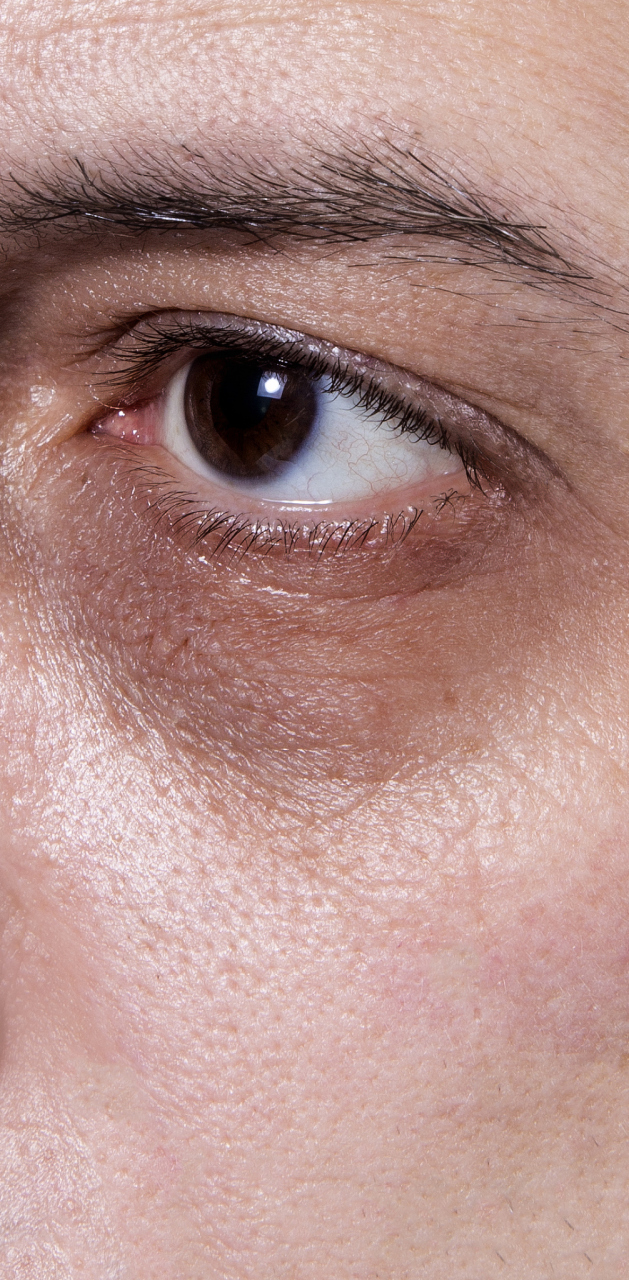 羊眼圈  羊眼圈是指眼部周围的皮肤出现凹陷和暗沉的情况,类似于羊眼