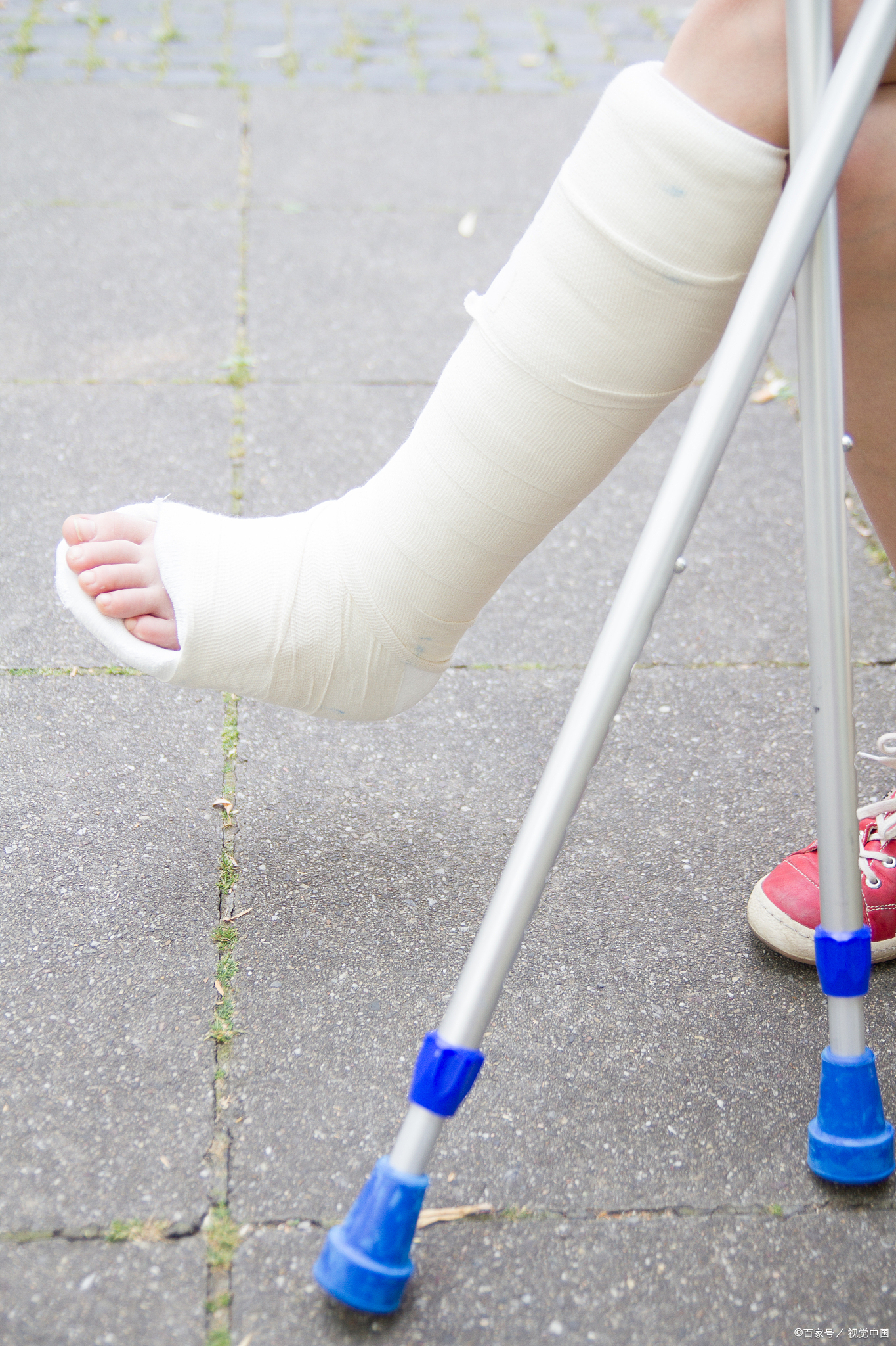 3%的速度流失,三个月能掉50石膏固定下肢打石膏大腿