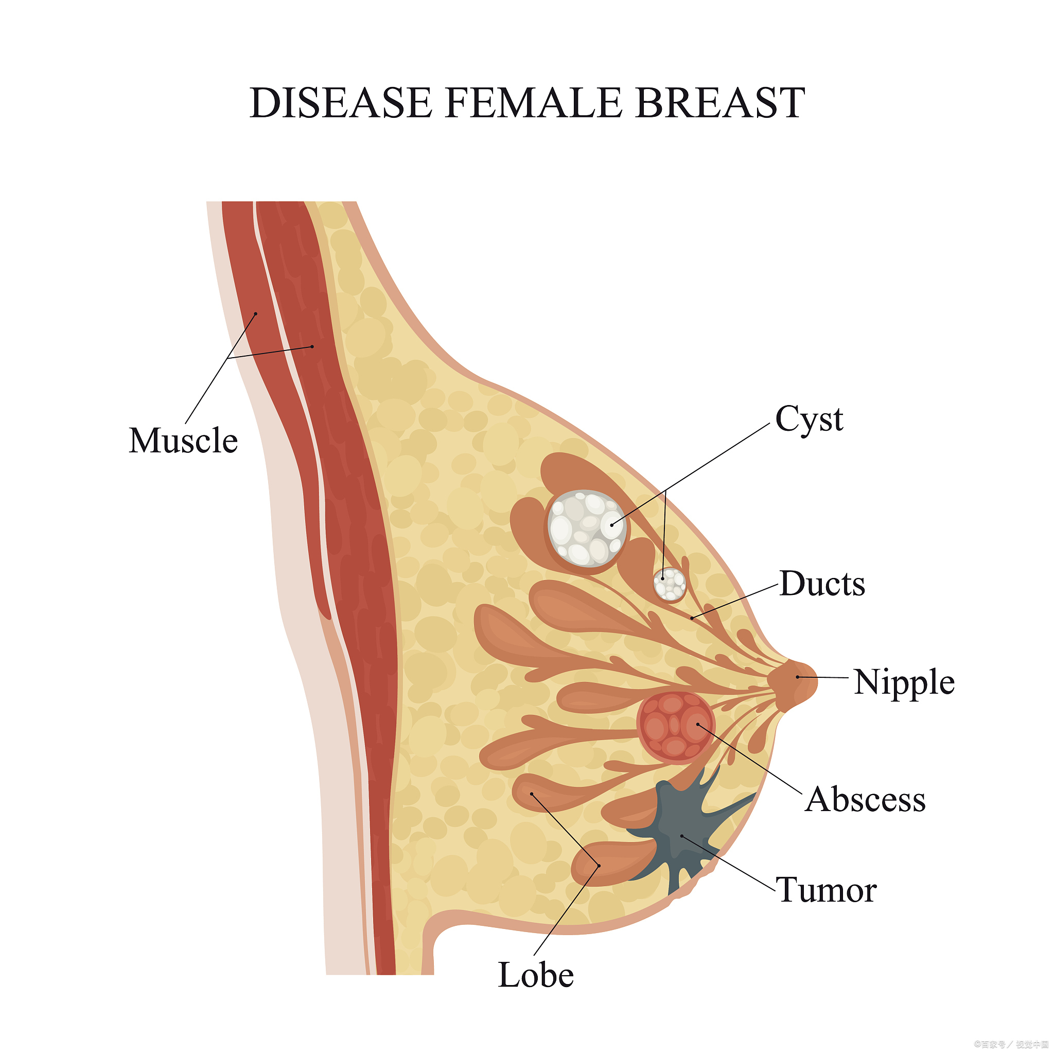 乳腺腺体致密图片