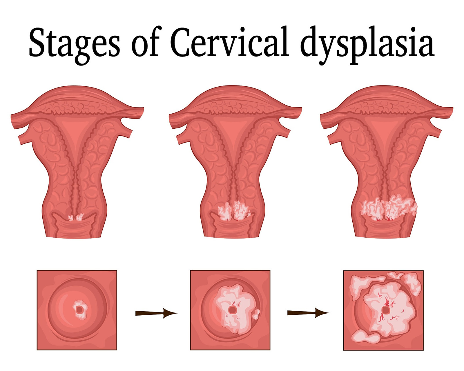 宫颈癌是指发生在女性生殖系统宫颈部位的一种恶性肿瘤