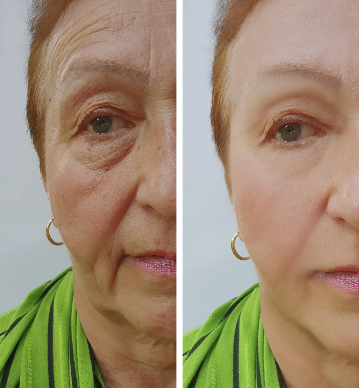 50岁眼皮松弛下垂最好解决方法  对于50岁眼皮松弛下垂的解决,有以下