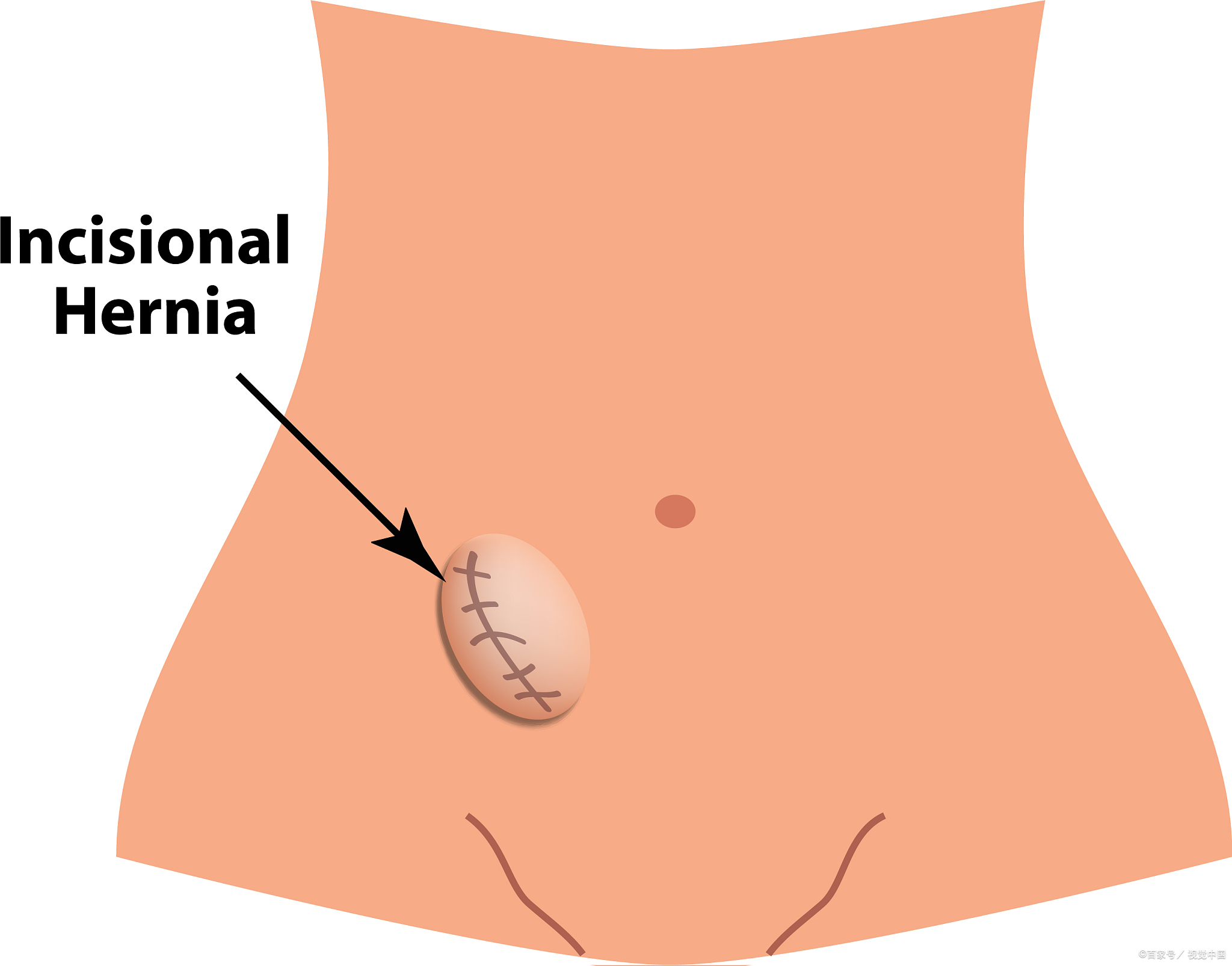 疝类型来分类,总共分为四类:一是可复性疝,二是难复性疝,三是嵌顿性疝