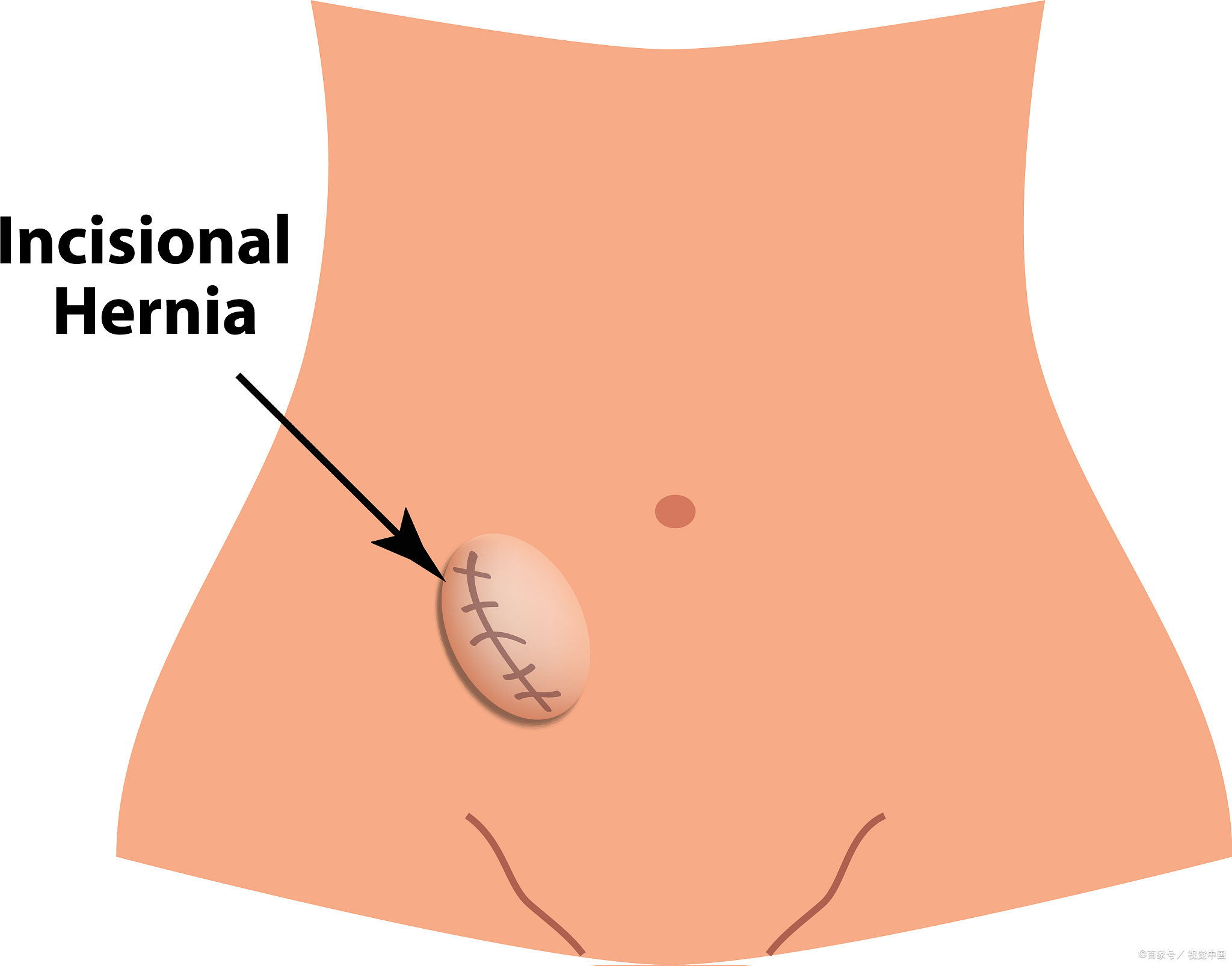 嵌顿疝腹股沟疝图片
