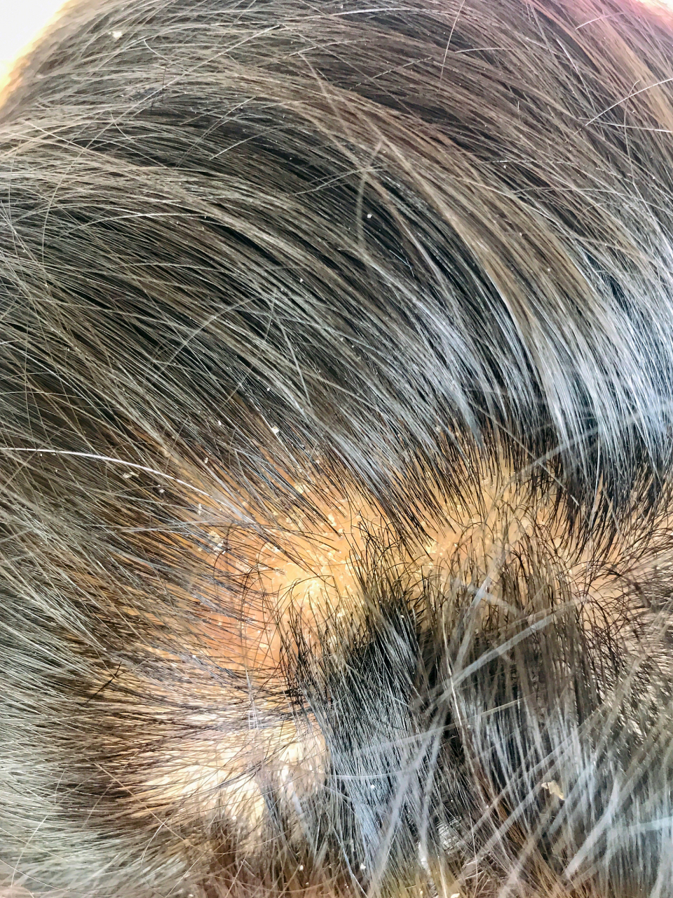 毛囊受到损伤和坏死有哪些区别?