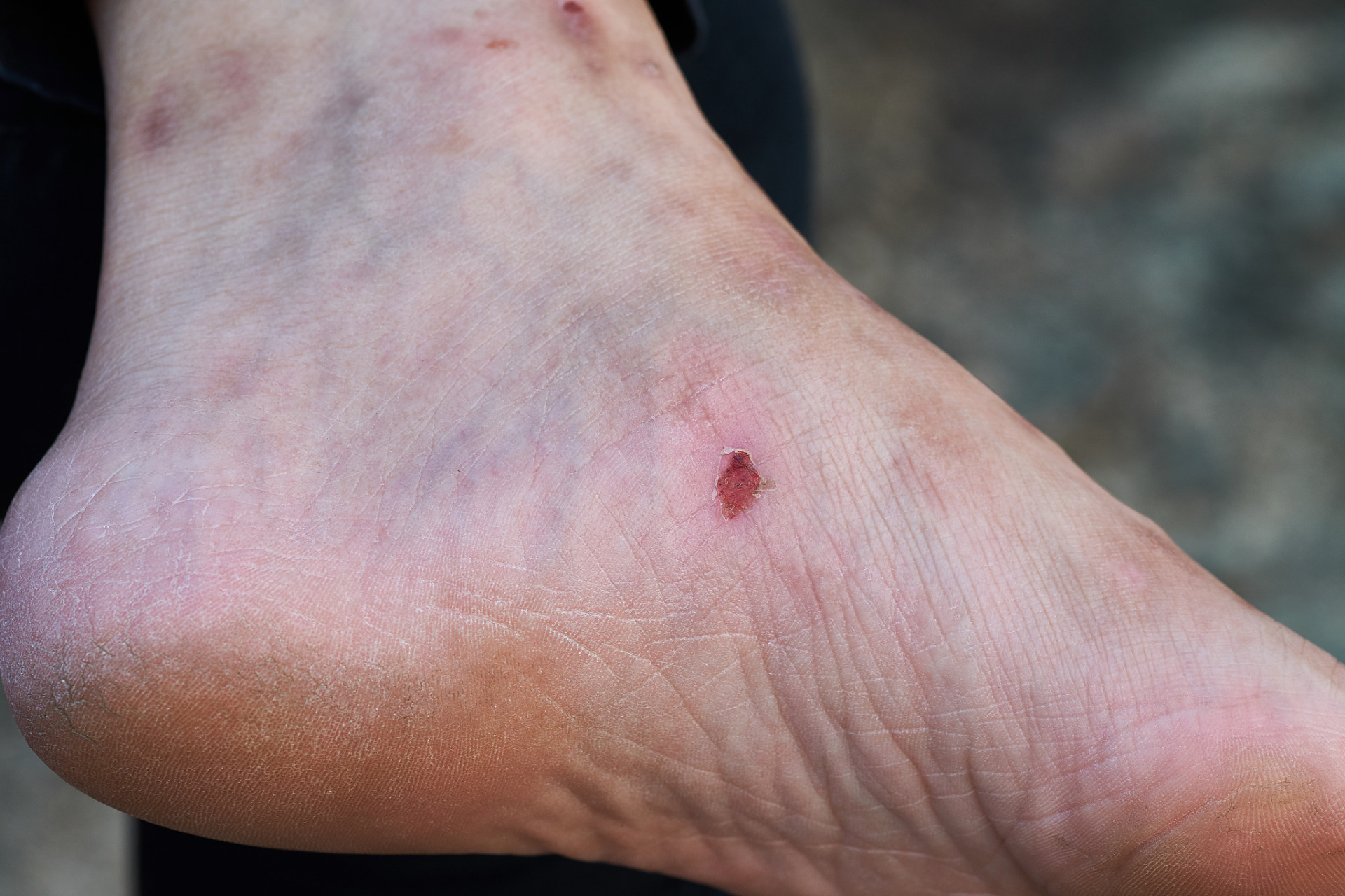 被蝎子咬伤?别急,先清洁伤口,冰敷止痛.少动肢体避免毒素扩散!