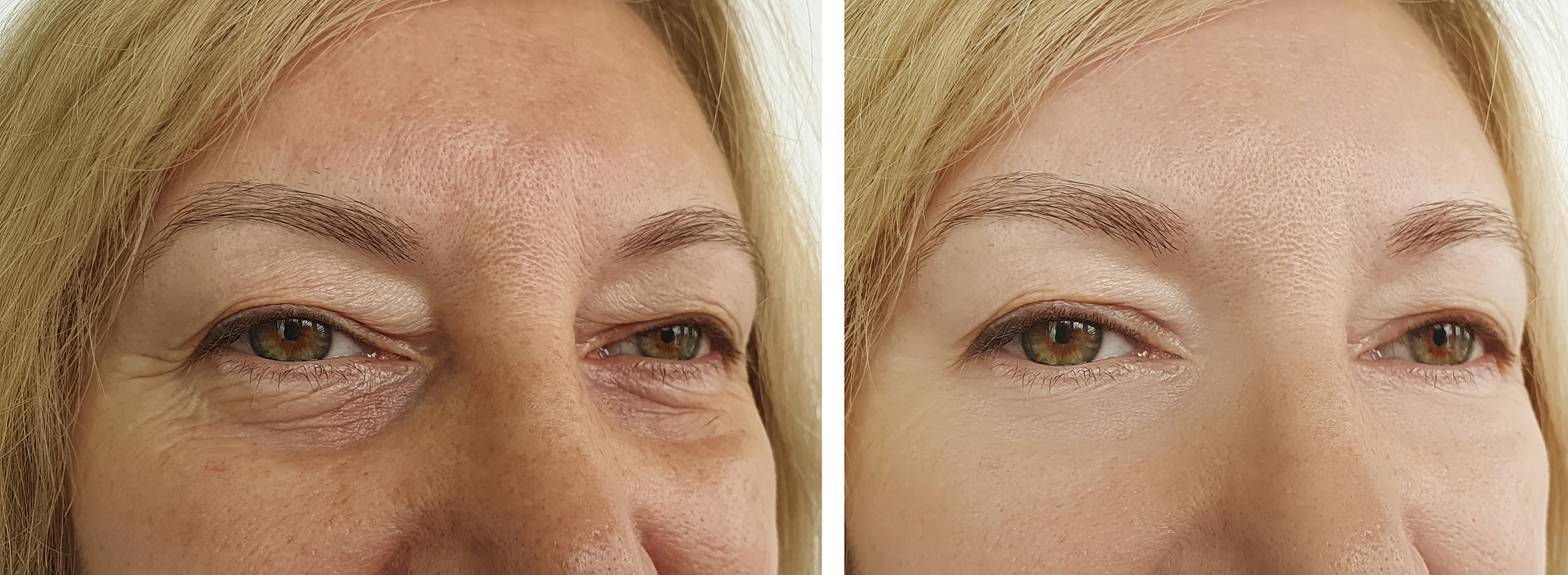 很多求美者在手术后常抱怨术后泪沟凹陷或是觉得眼袋没移除干净,其实