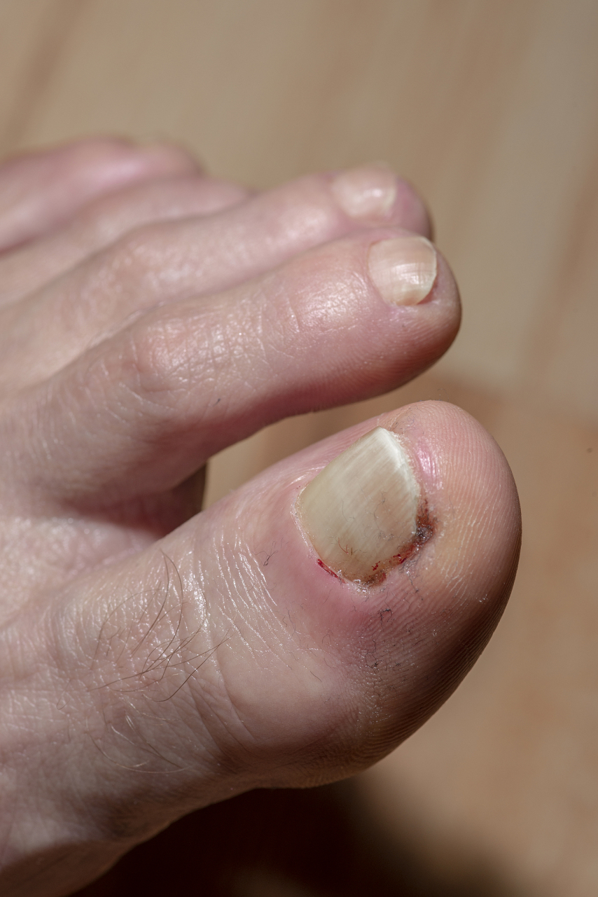 指甲长进肉里面该怎么办?营养师来支招!