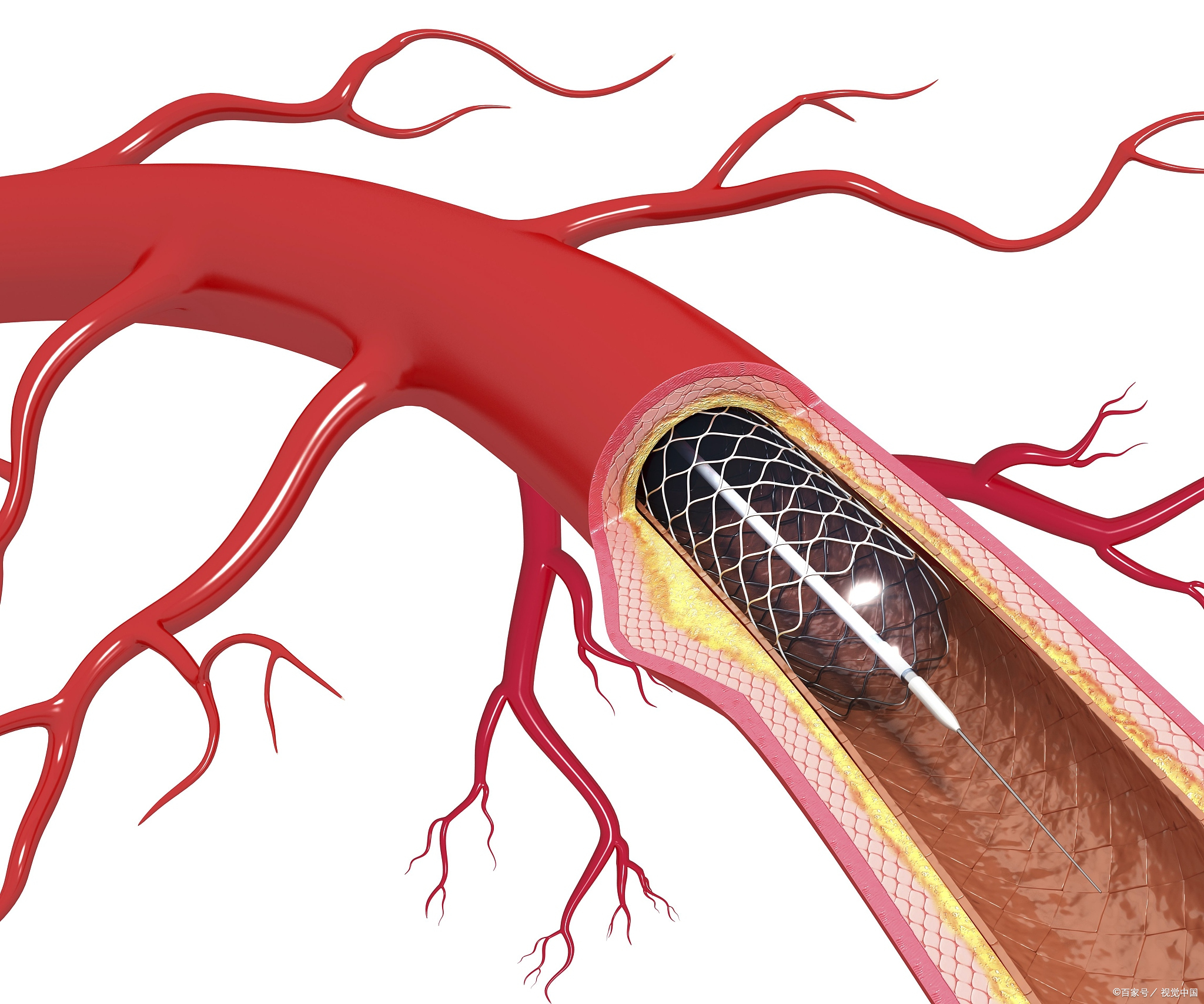 血管支架原理图图片
