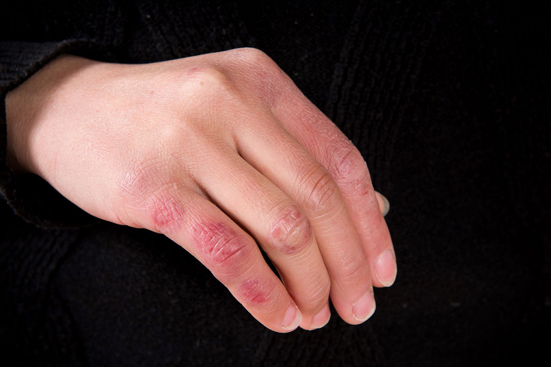 相信很多人都跟我一样,想要在寒冷的冬天里找到一些防冻疮的方法.