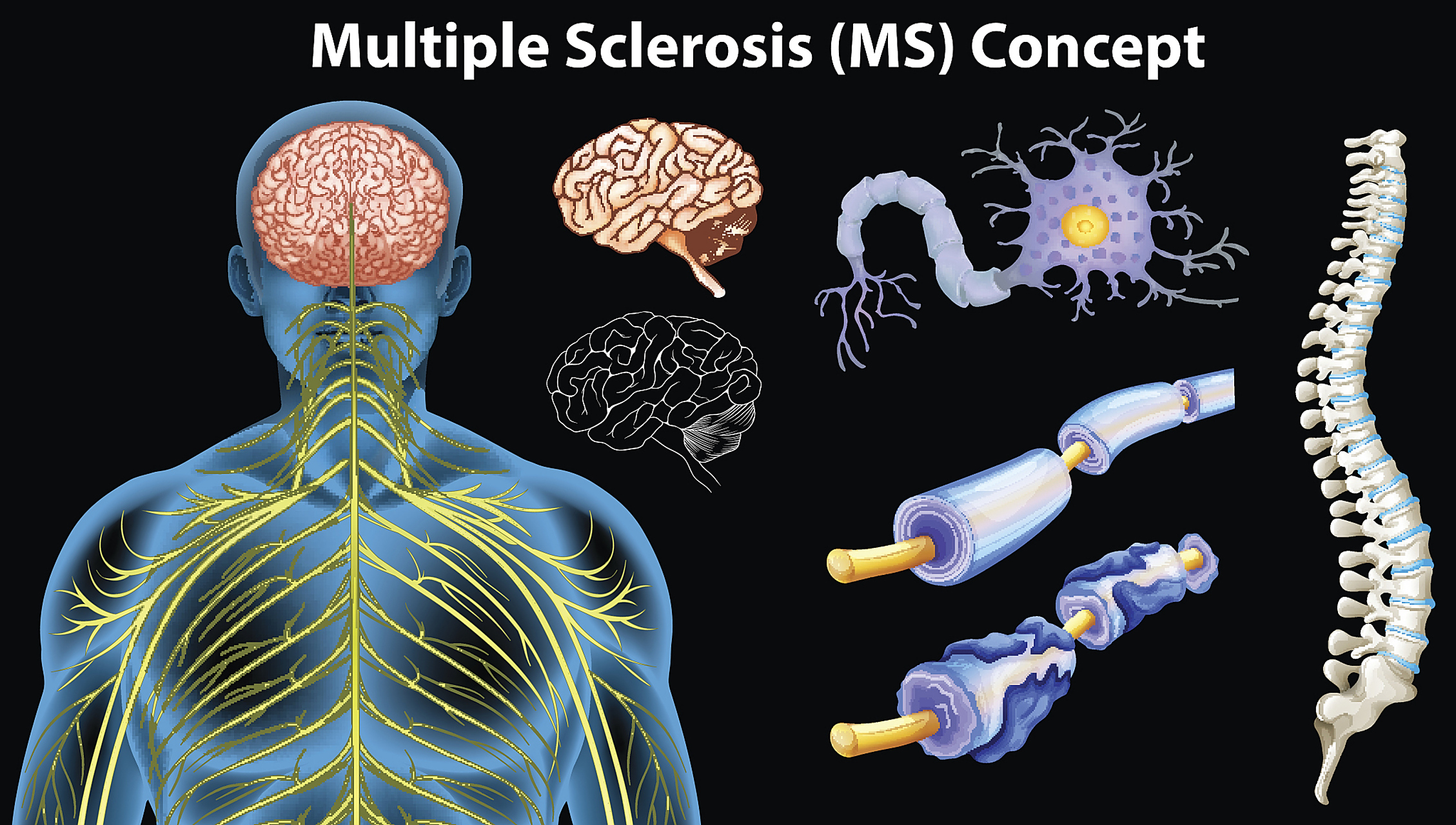 症患者日常生活需要注意哪些问题  多发性硬化症(multiple sclerosis