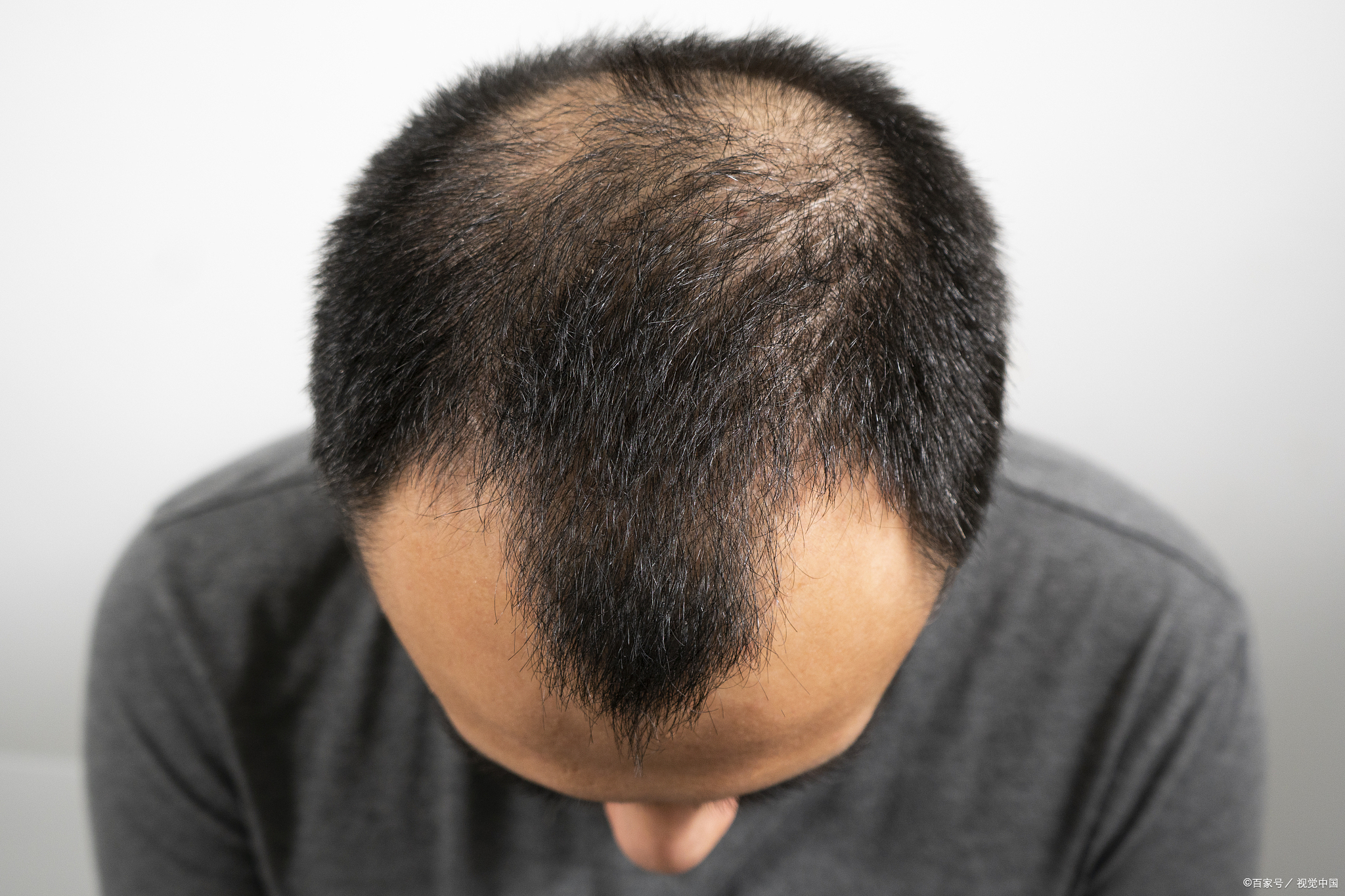 优质作者榜# 烫发的原理.@脱发医生李化冰的动态