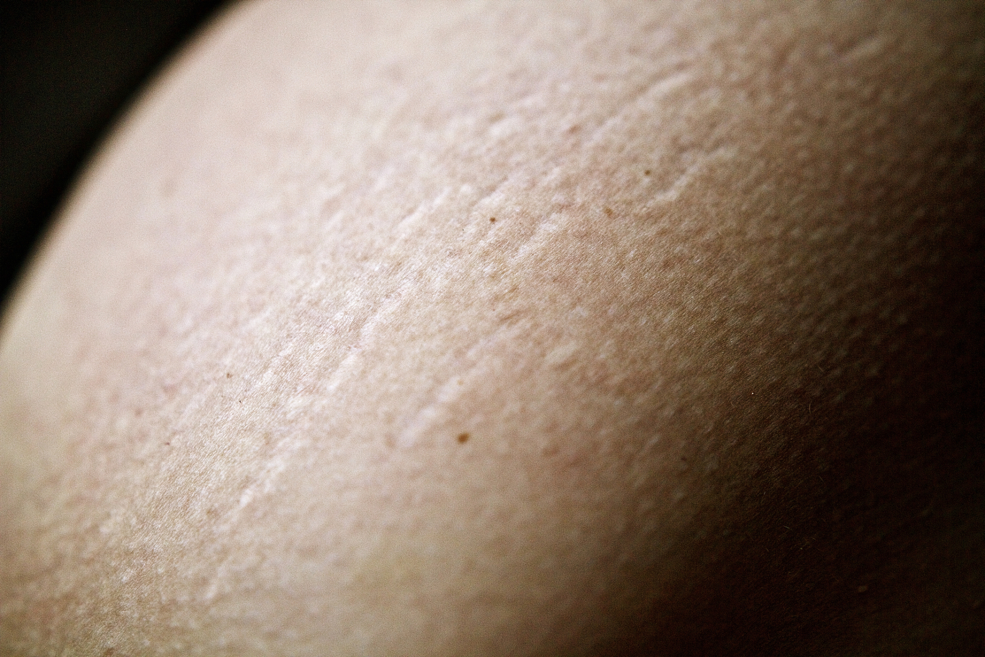 生长纹,也被称为膨胀纹或萎缩纹,是皮肤上出现的一种纹路,通常出现