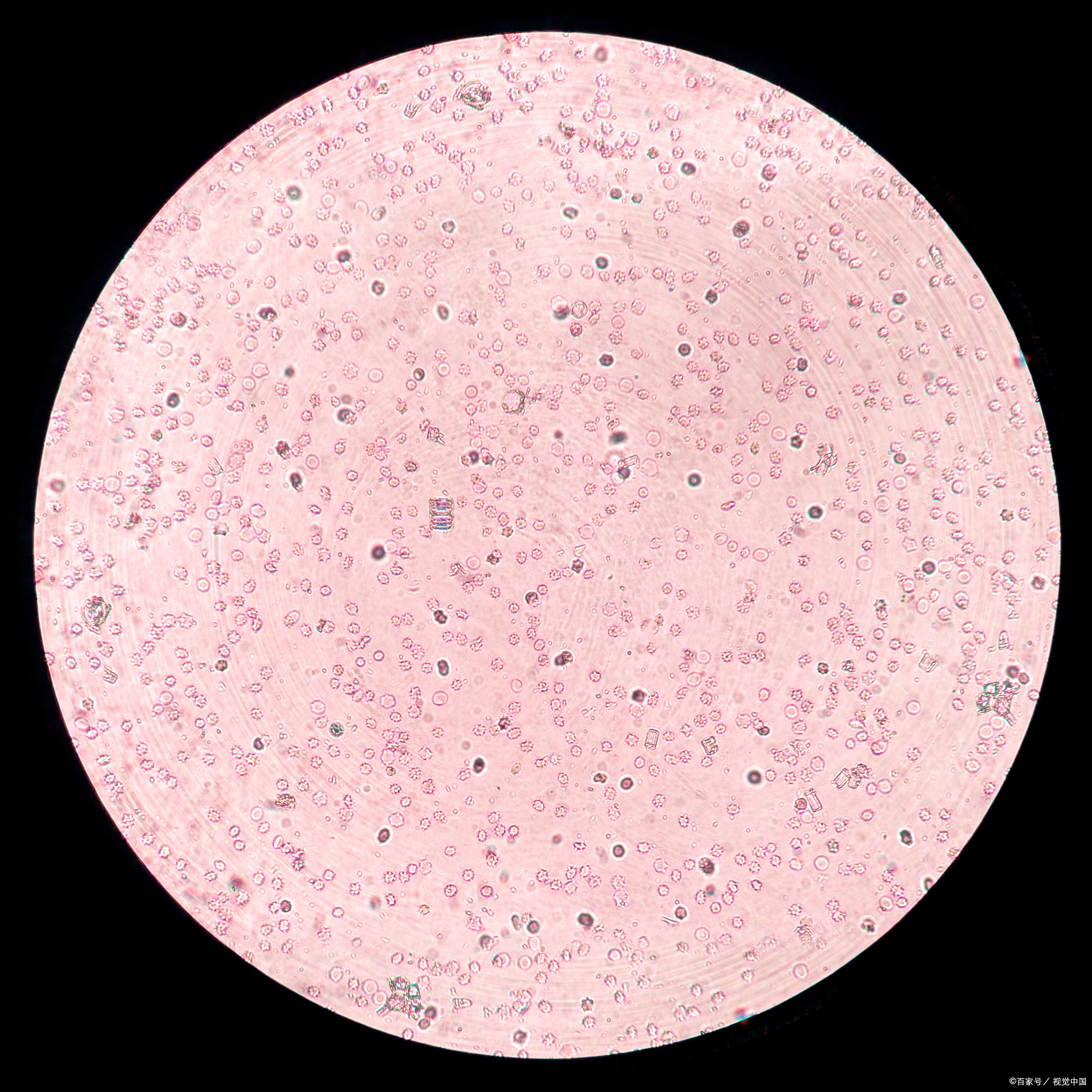 缺铁性贫血是由于体内铁储备不足,无法满足正常红细胞生成的需要而
