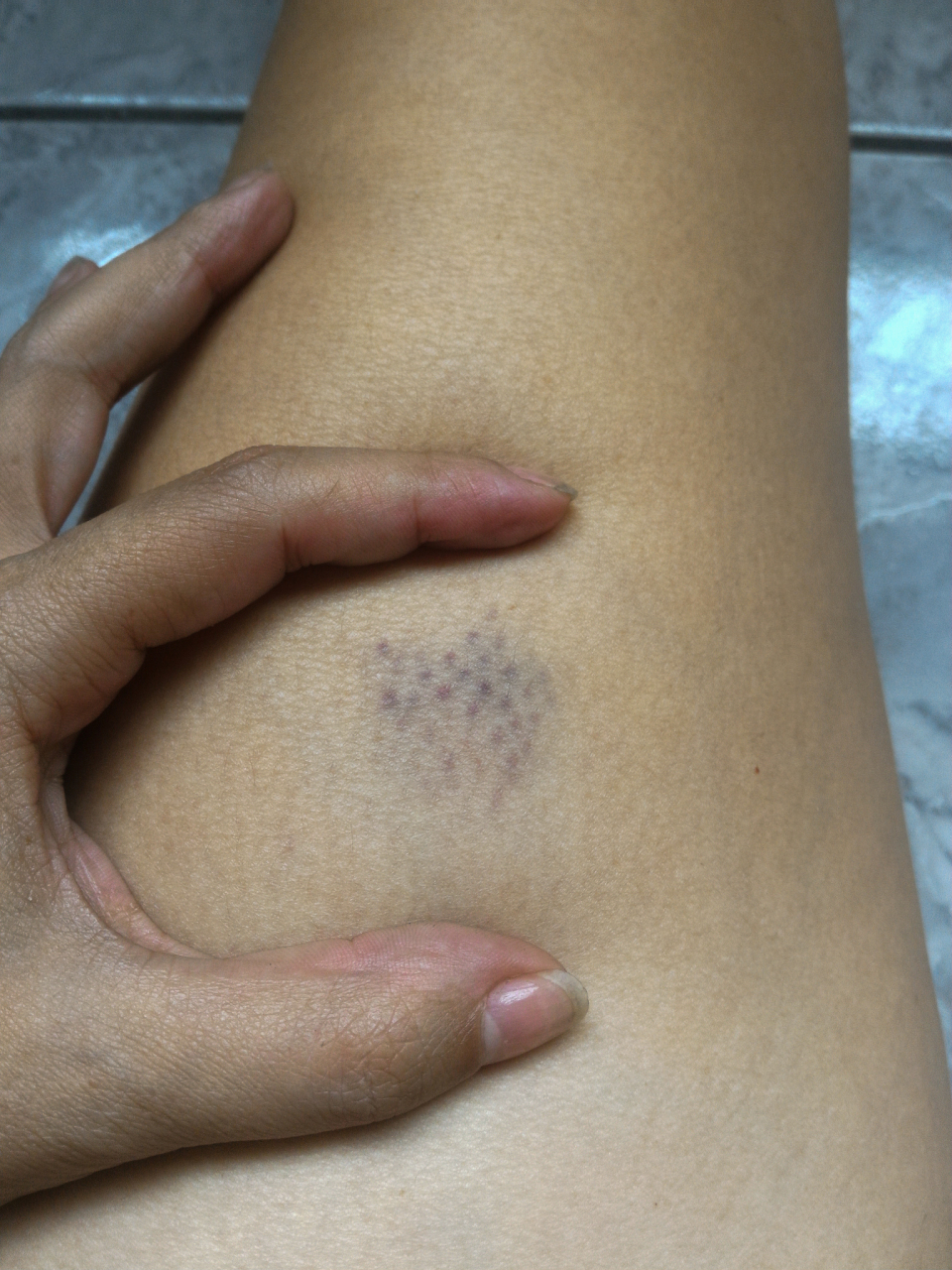 "肚皮针"导致皮下硬结,瘀斑,怎么办?