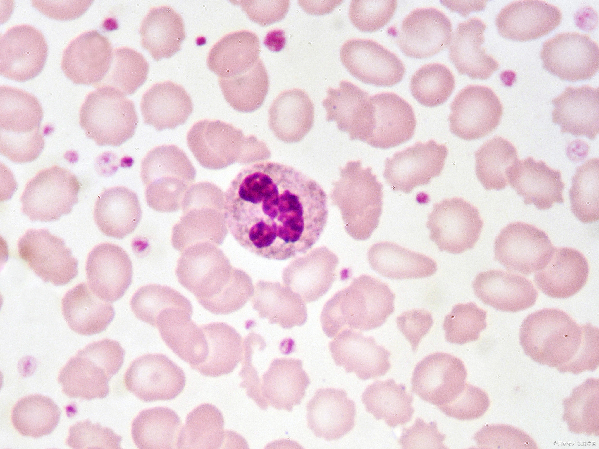 嗜碱性粒细胞明显升高