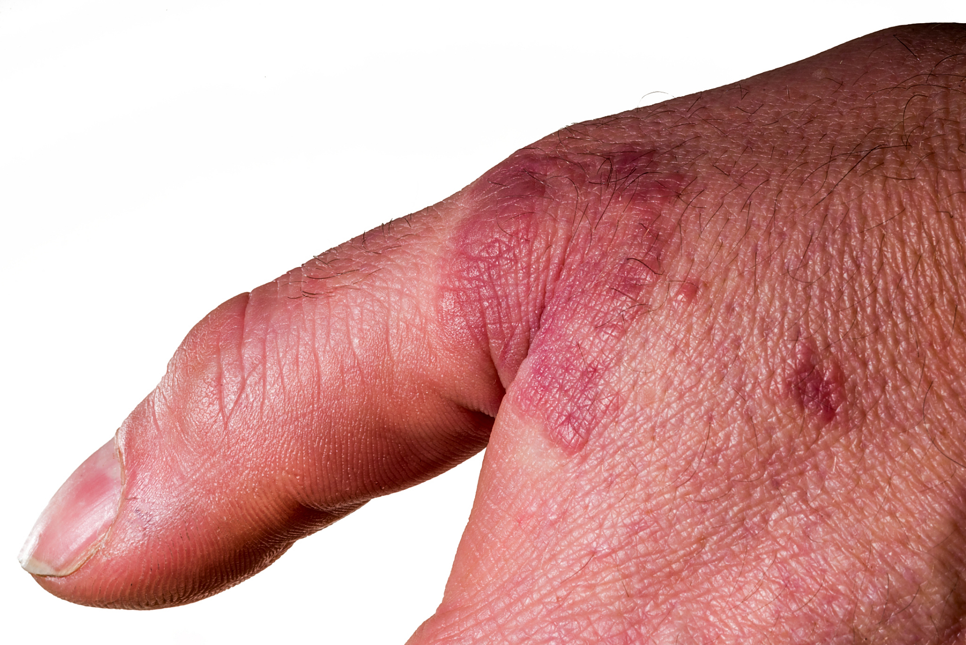 皮炎和皮癣的区别!