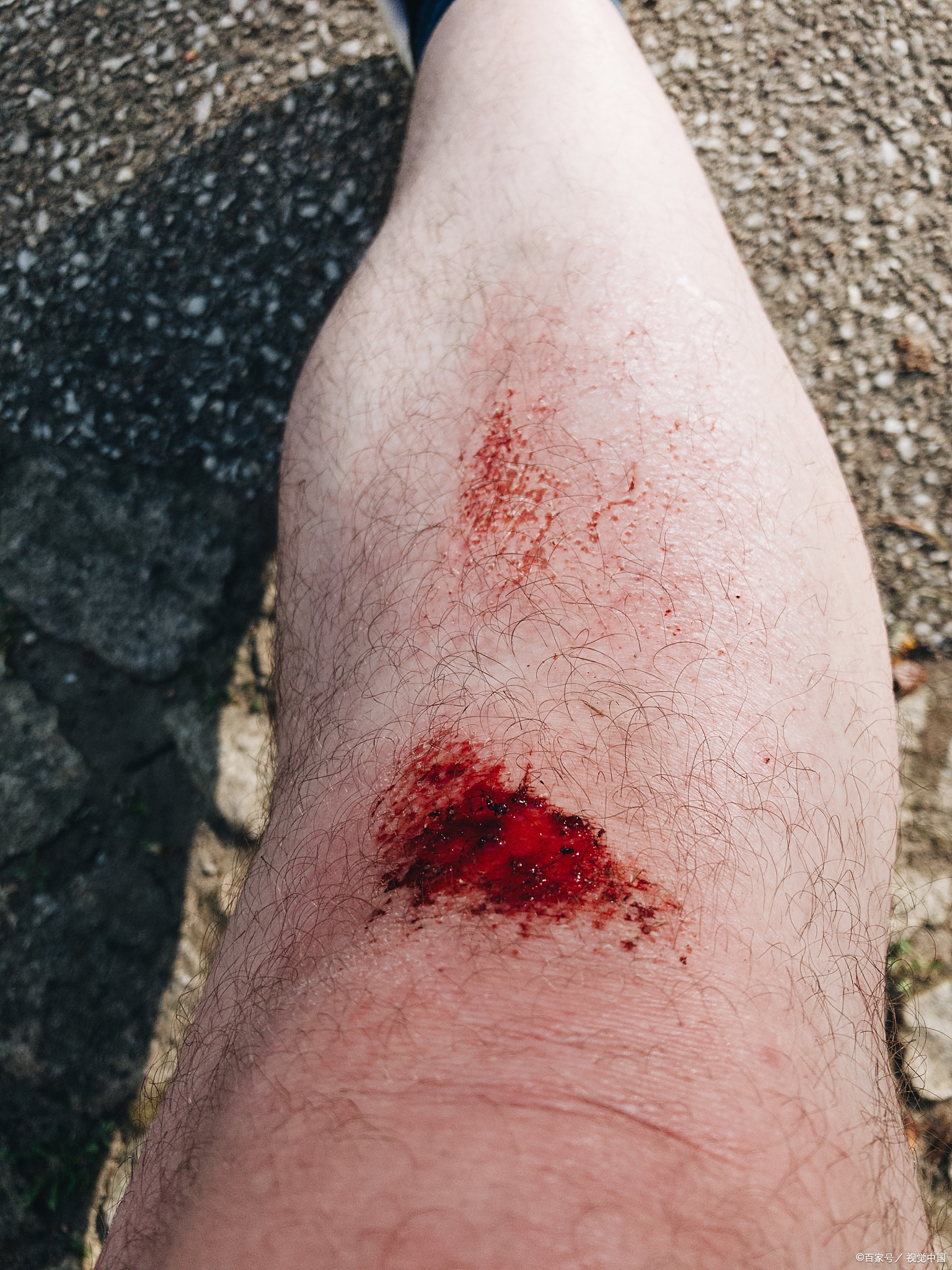 脚趾紫色淤血什么原因 脚趾出现紫色淤血,是一种常见现象,通常源于皮