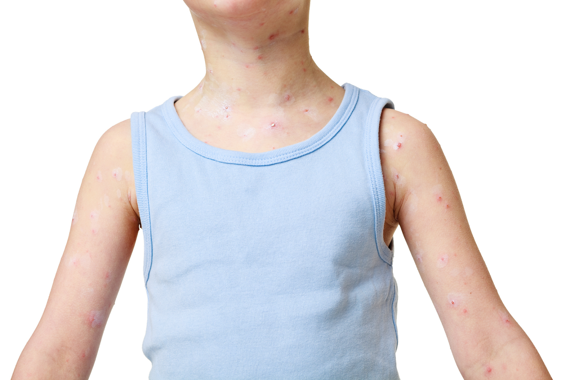 水痘疫苗并非只是儿童的专利,对于成年人来说,同样具有重要意义.