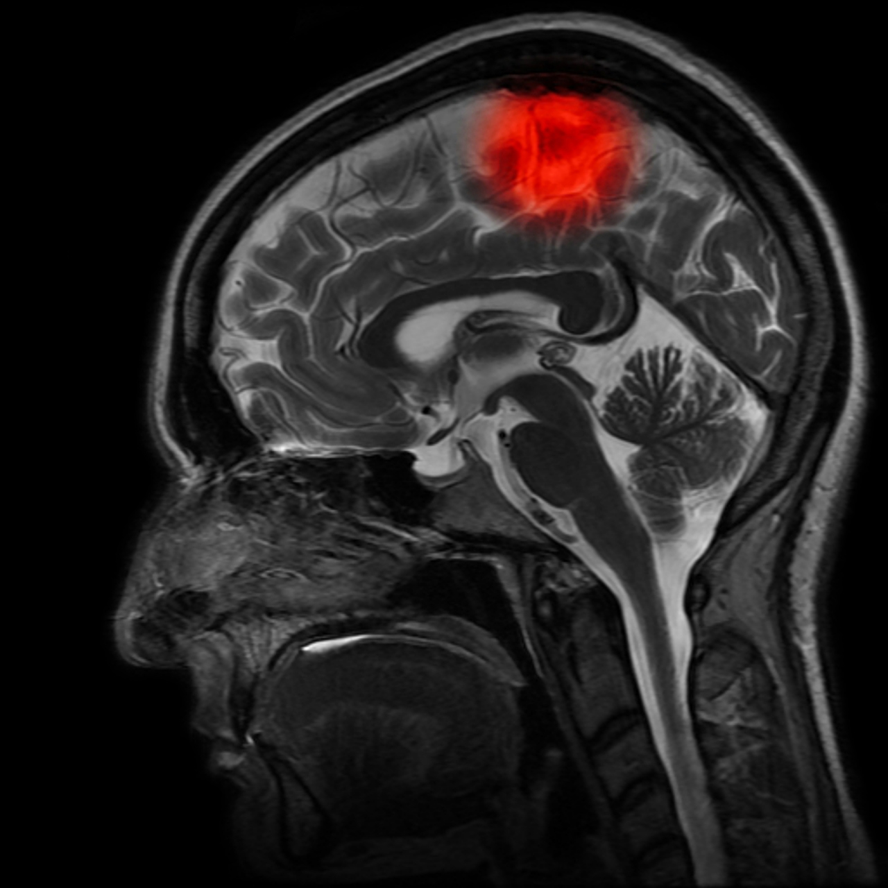 所以绝大多数垂体囊肿不需要治疗,只有引起症状了才需要解决.