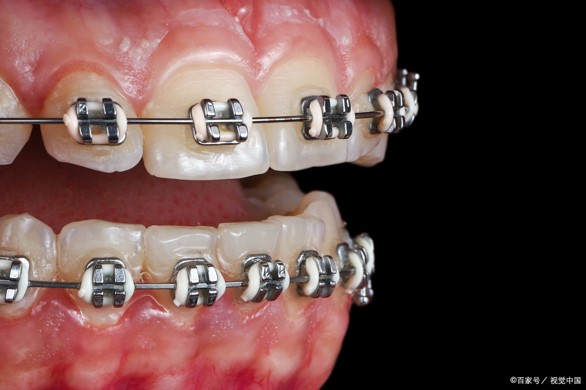 家长必看 儿童口腔早矫干货指南