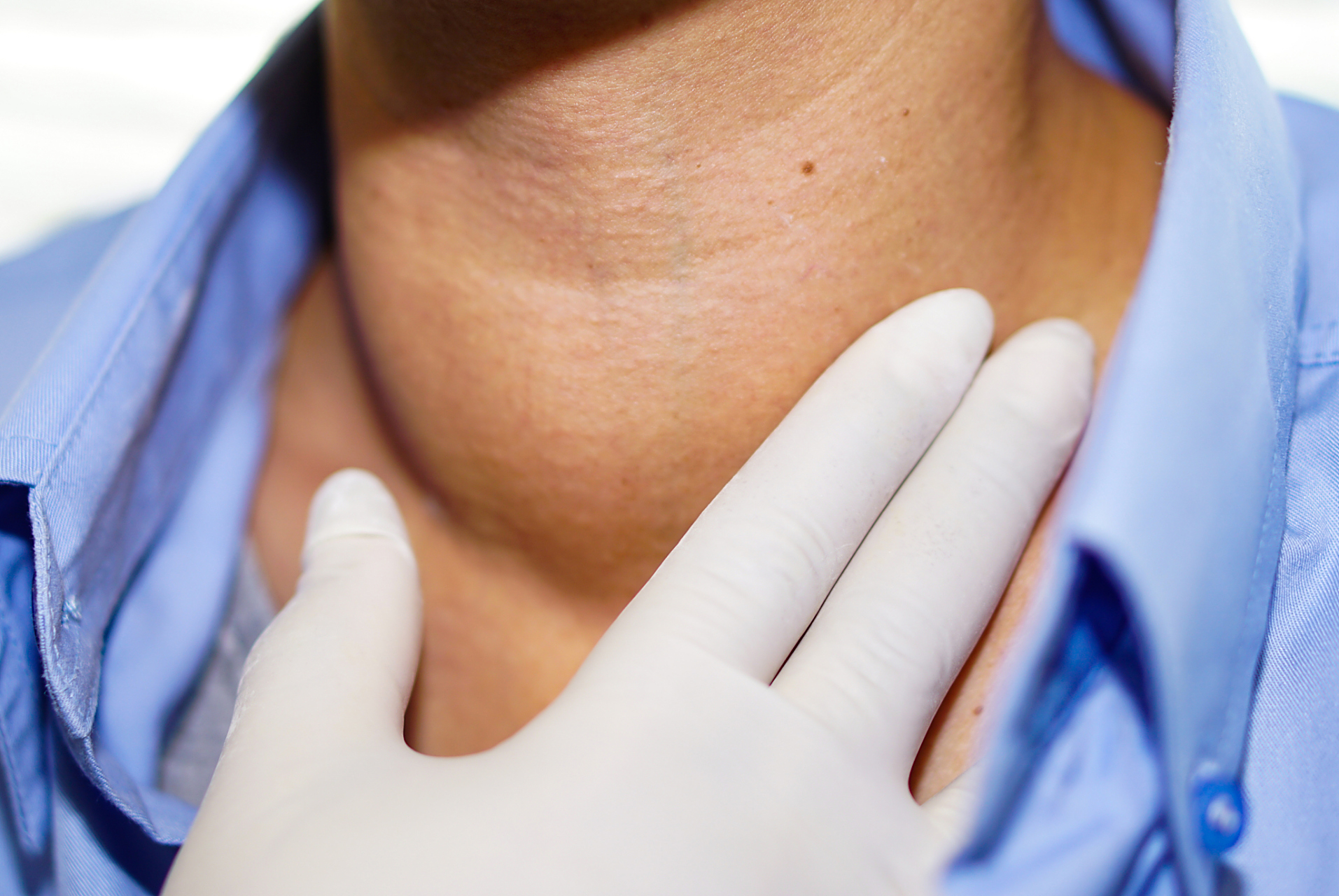 经常咽喉部及甲状腺区疼痛,向耳后,下颌部放射,伴有甲亢的症状,甲状腺