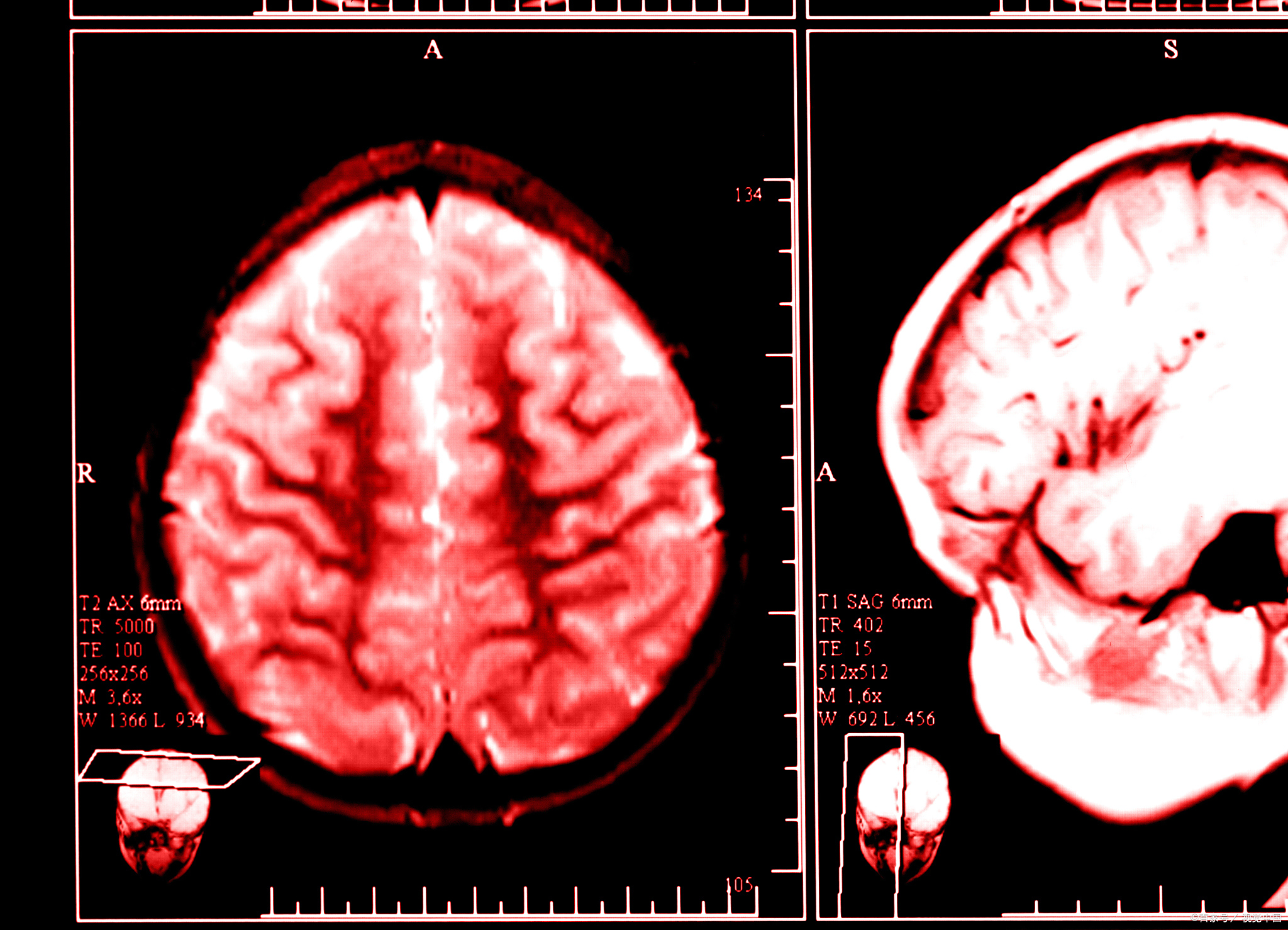 蛛网膜下腔出血,这一听起来颇为专业的医学名词,其实离我们并不遥远.