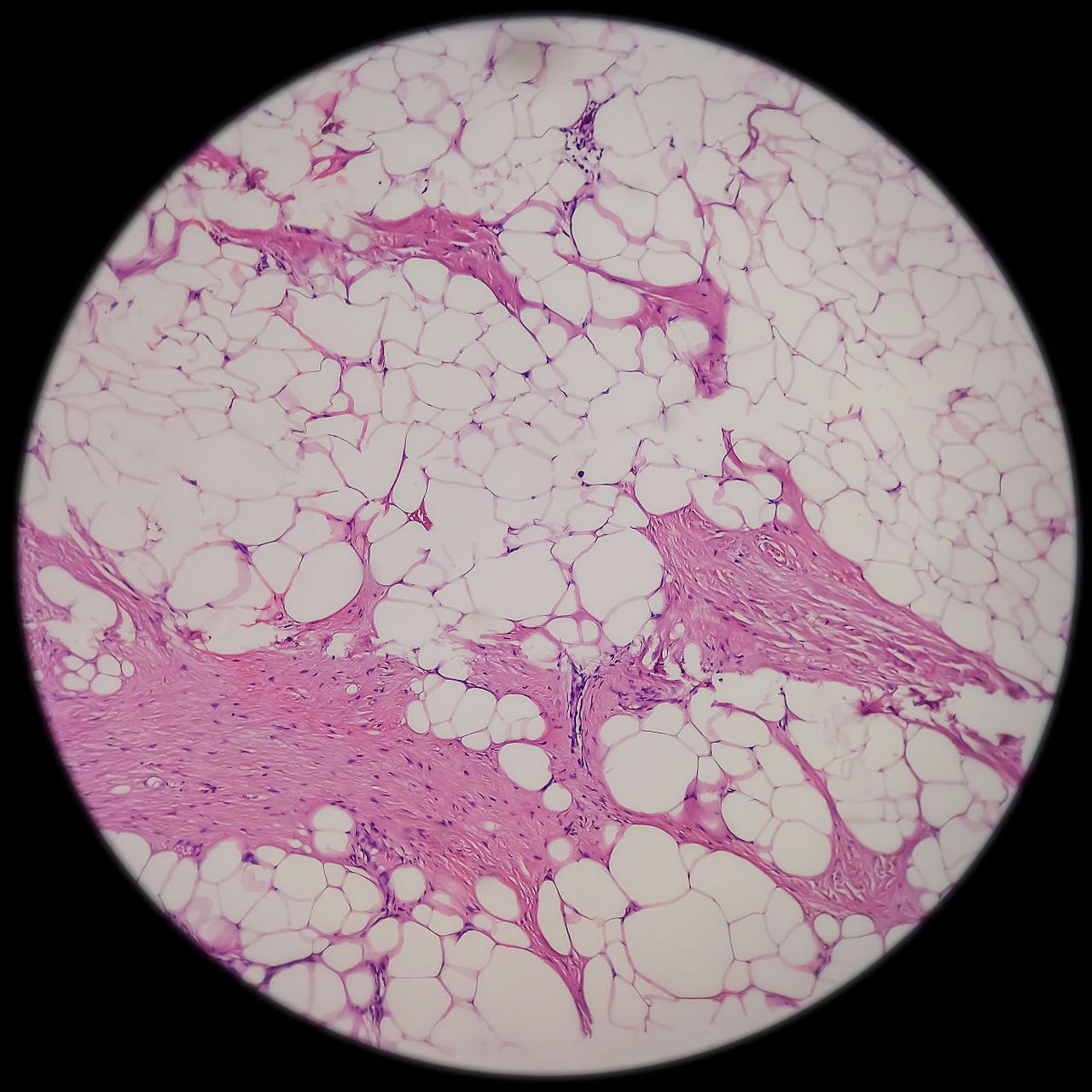 脂肪母细胞瘤,又称为脂肪瘤,是一种罕见的肿瘤,通常发生在婴幼儿和