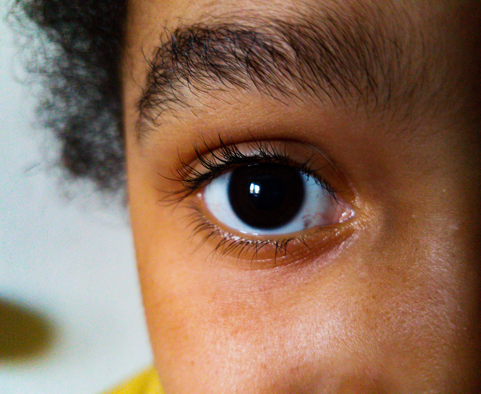 【婴儿倒睫毛该如何治疗?