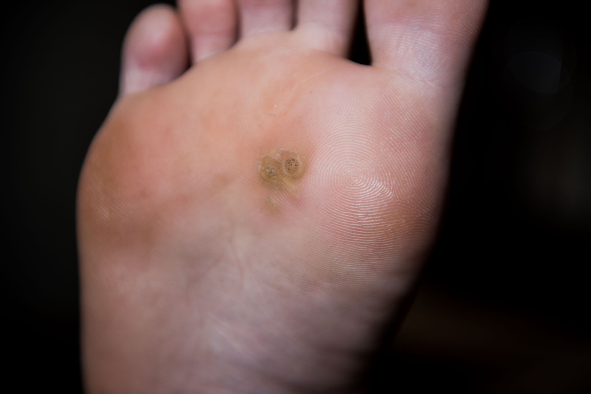 邯郸燕赵中医院皮肤科医生:足底跖疣是怎么形成的?