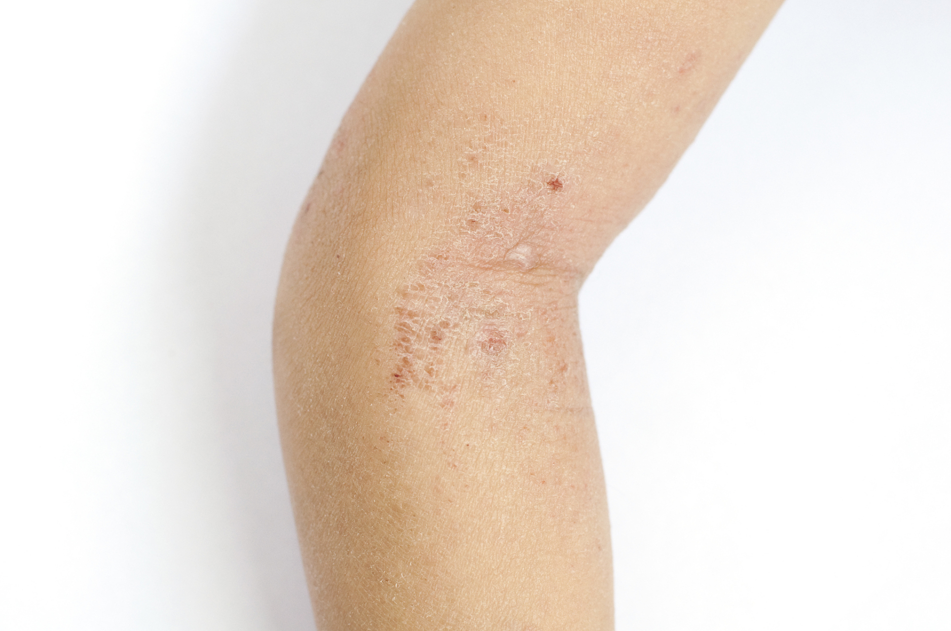 时间因人而异,科学治疗是关键 皮肌炎,其实是一种累及皮肤和肌肉的