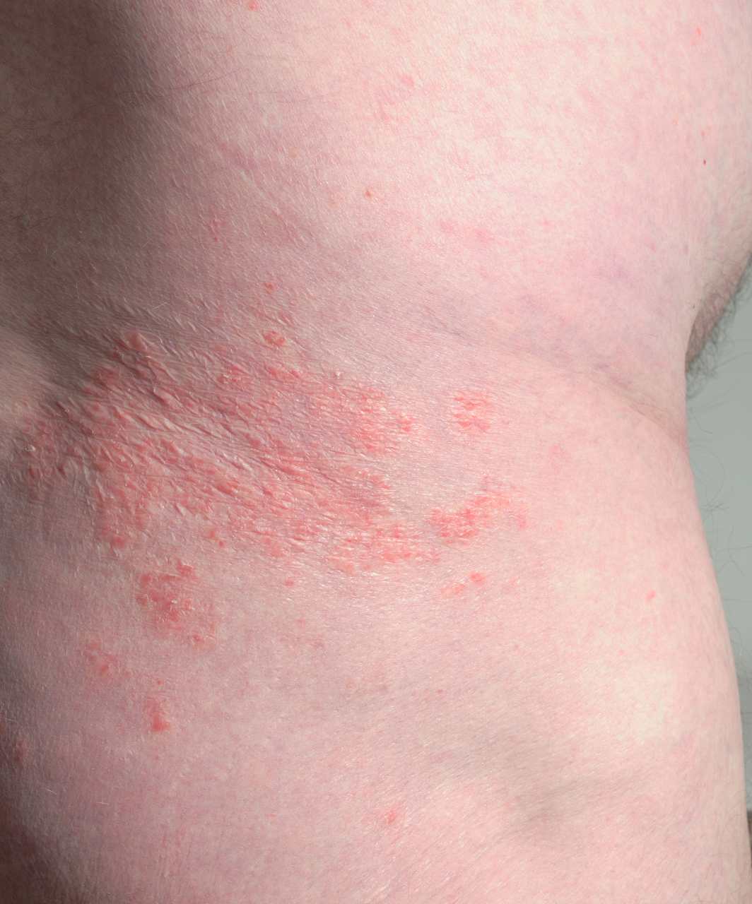 混合性血管瘤可以自动消退吗?