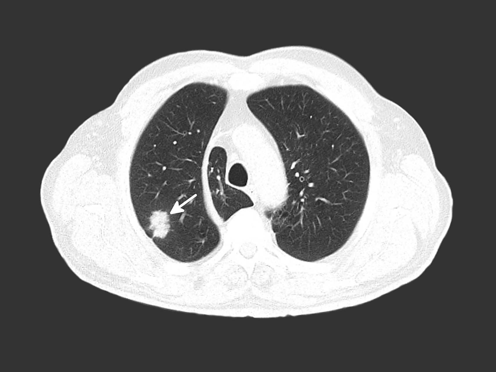 肺大泡,是指一个局限性的肺气肿,要避免剧烈运动,戒烟 2.