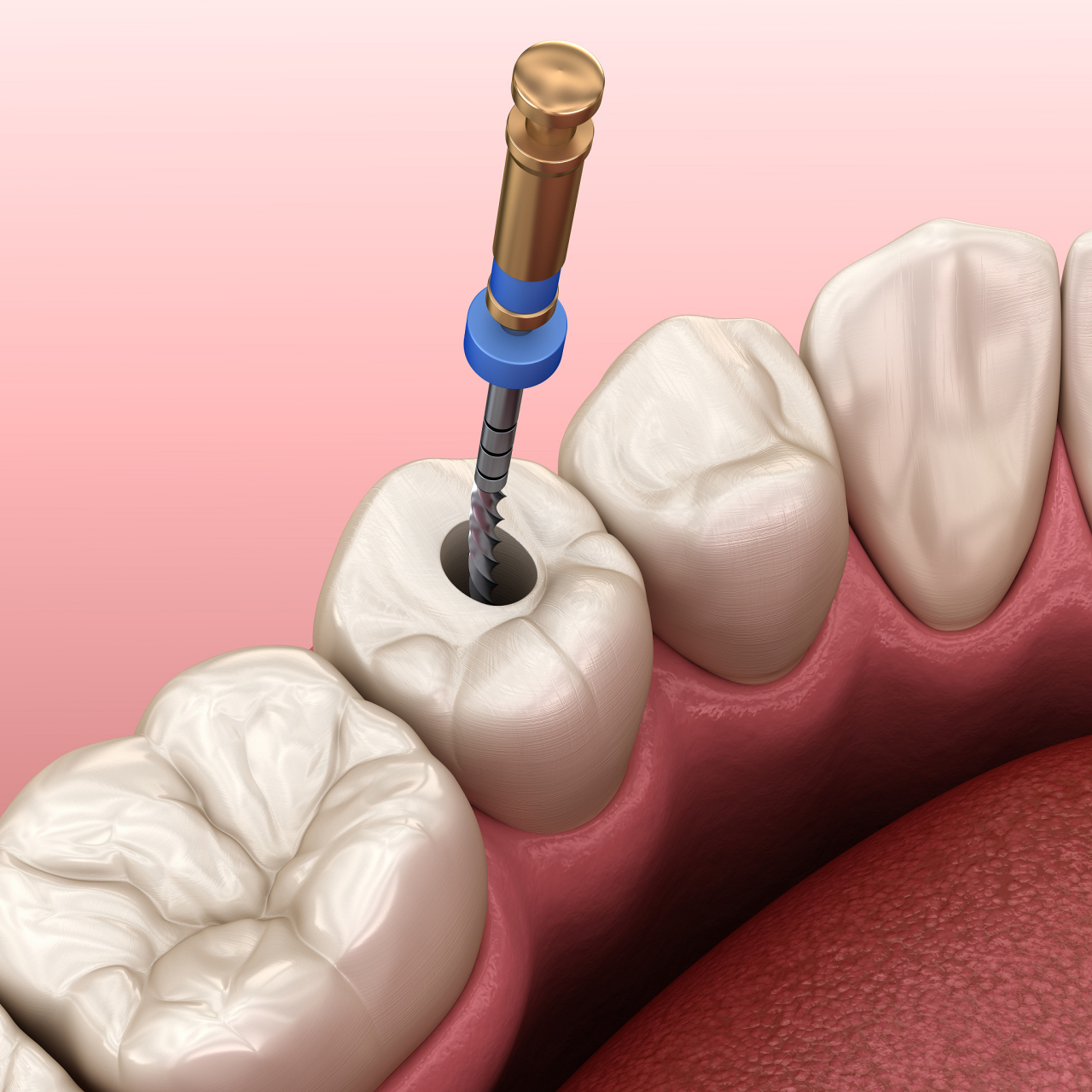 牙齿杀神经封药后一般会痛2-3天左右.