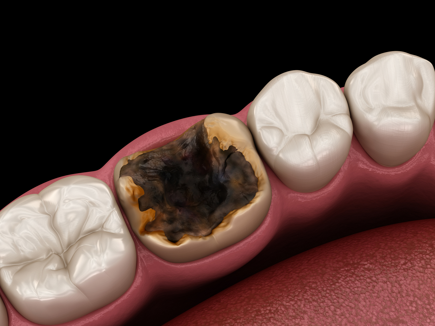 怎么预防急性牙髓炎?