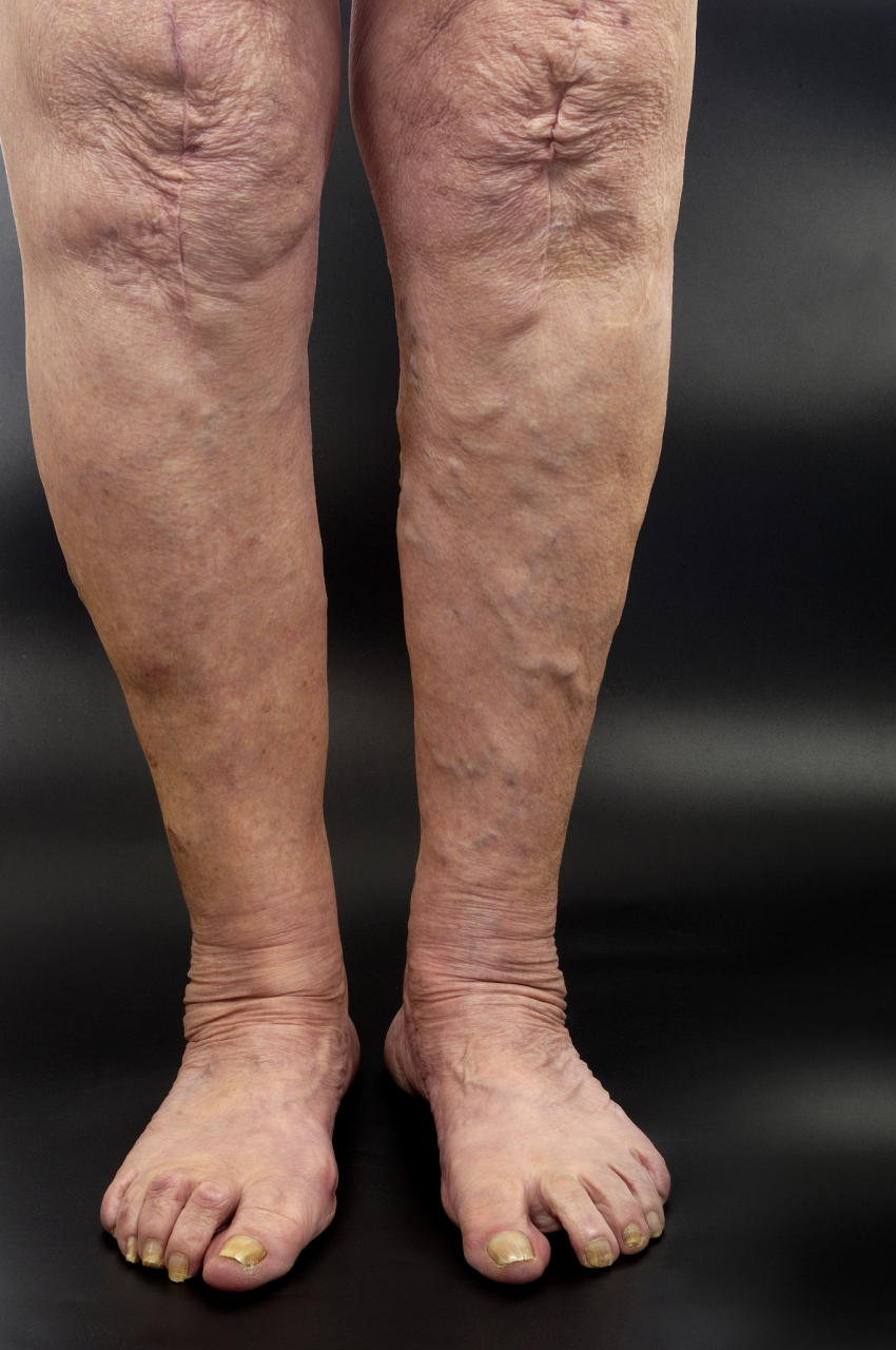 下肢静脉曲张会自己恢复吗?  静脉曲张作为多发疾病,因为一些患者没有