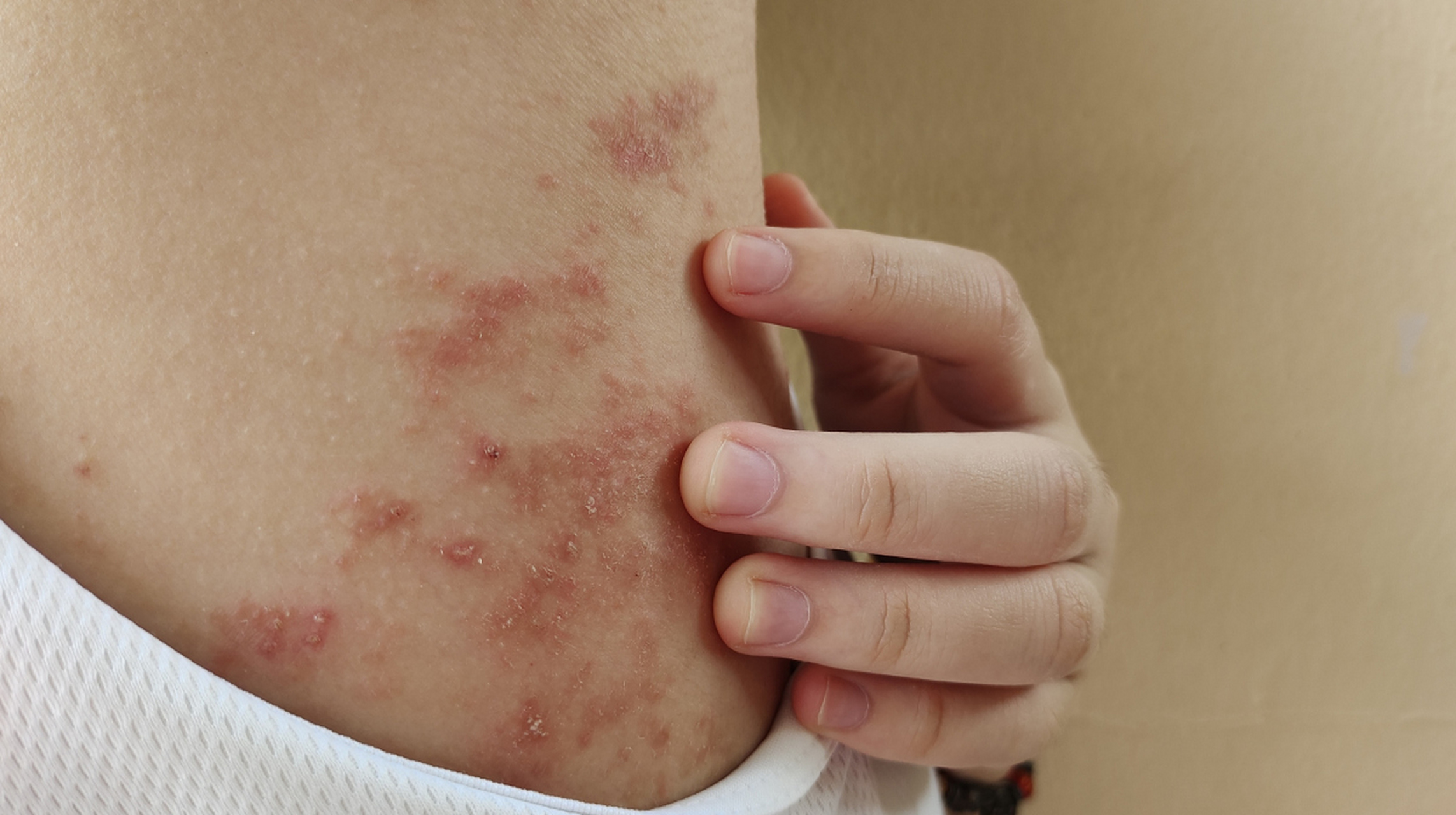 血热型荨麻疹怎么治疗图片