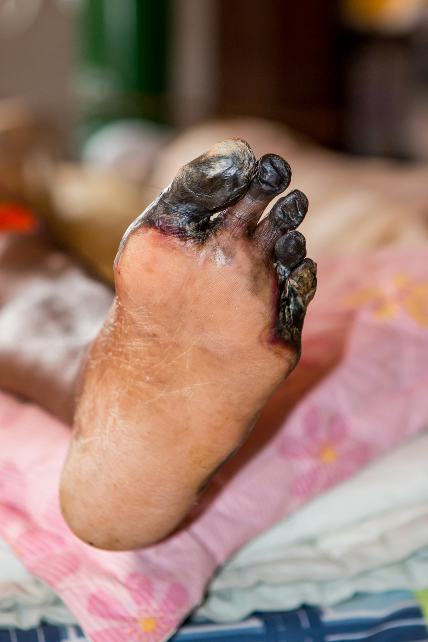 惠州的杜叔(化名)患有糖尿病7年,高血压16年,前段时间出现了右脚