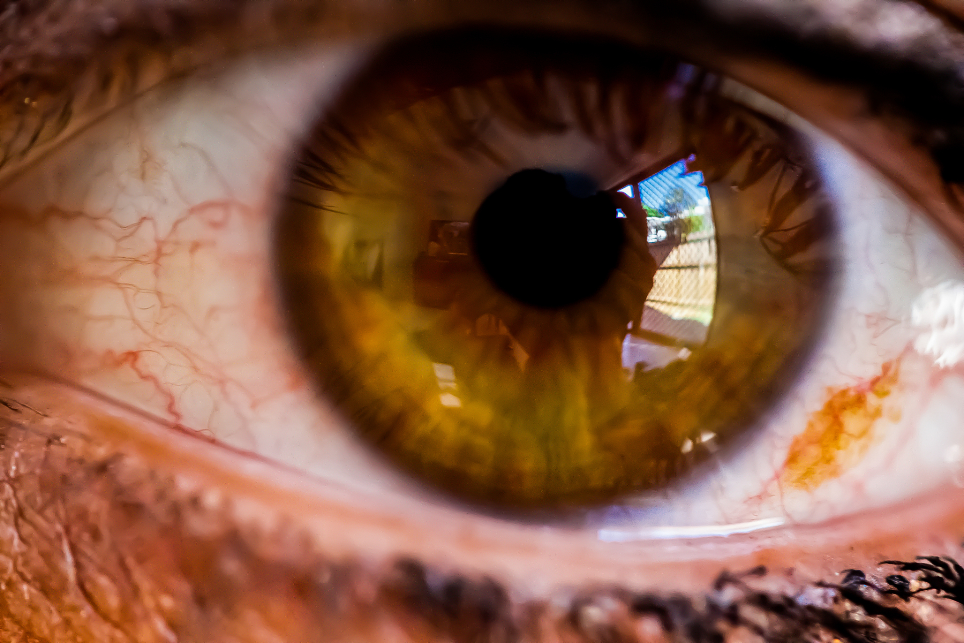 1,生理性飞蚊症:一点,两点的黑影,在眼睛周围会出现,这种情况,是断