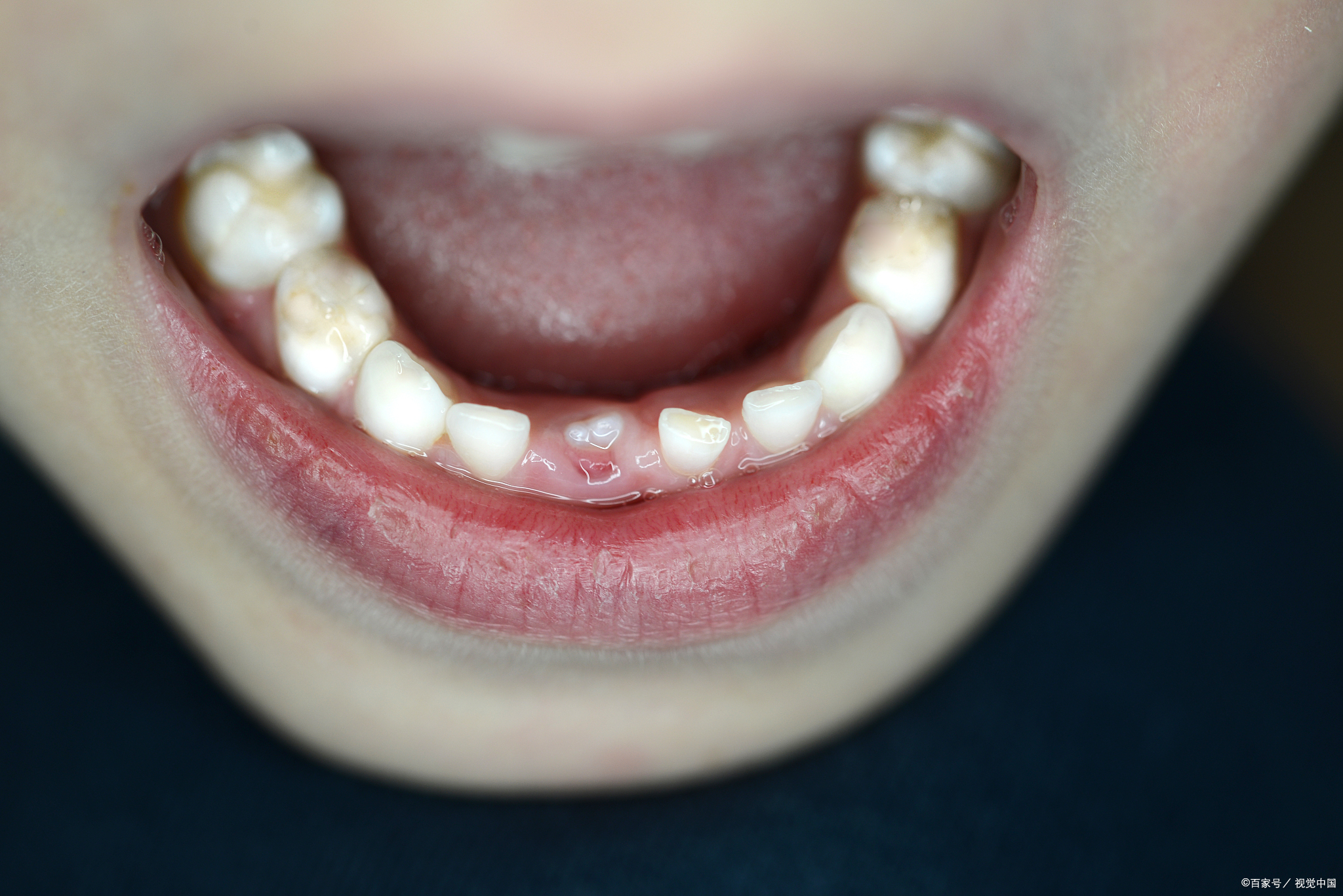 【儿童换牙期应该注意什么?