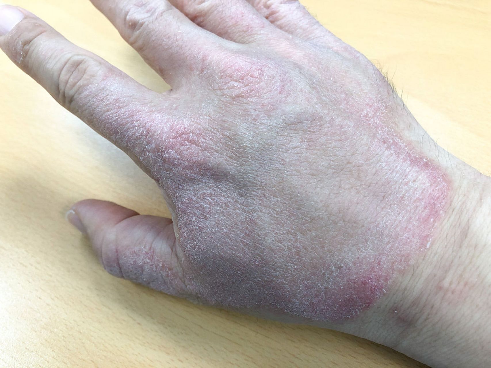 湿疹反复发作时瘙痒难耐  很多患者会用热水去烫,注