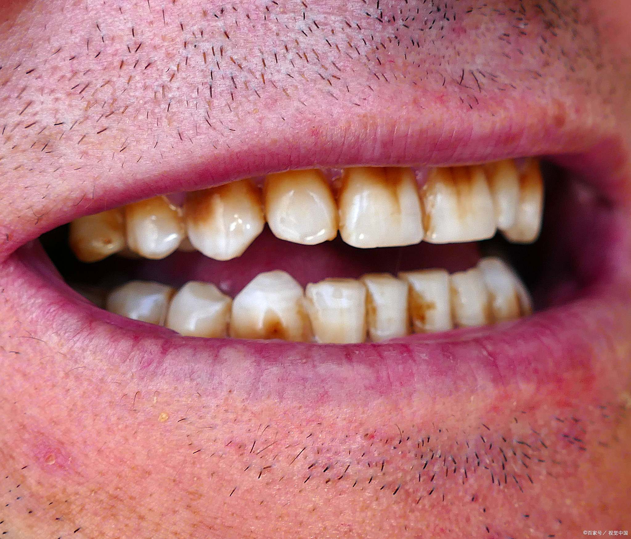 烟民牙齿发黑的主要元凶是焦油 尼古丁,这些黏糊糊的化学物质会钻进牙