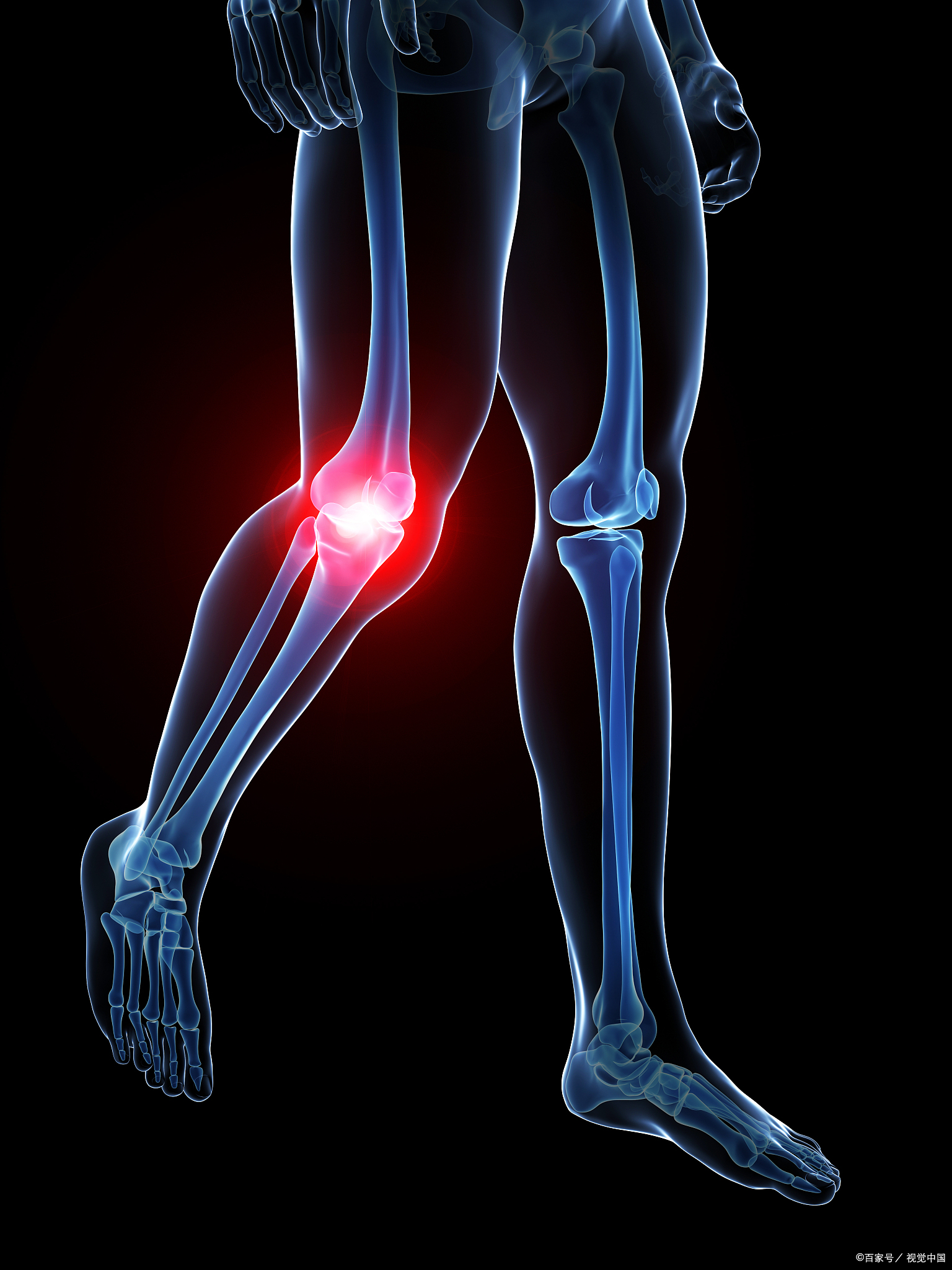 外侧副痛(lcl)是防止膝关节内翻的首要结构.