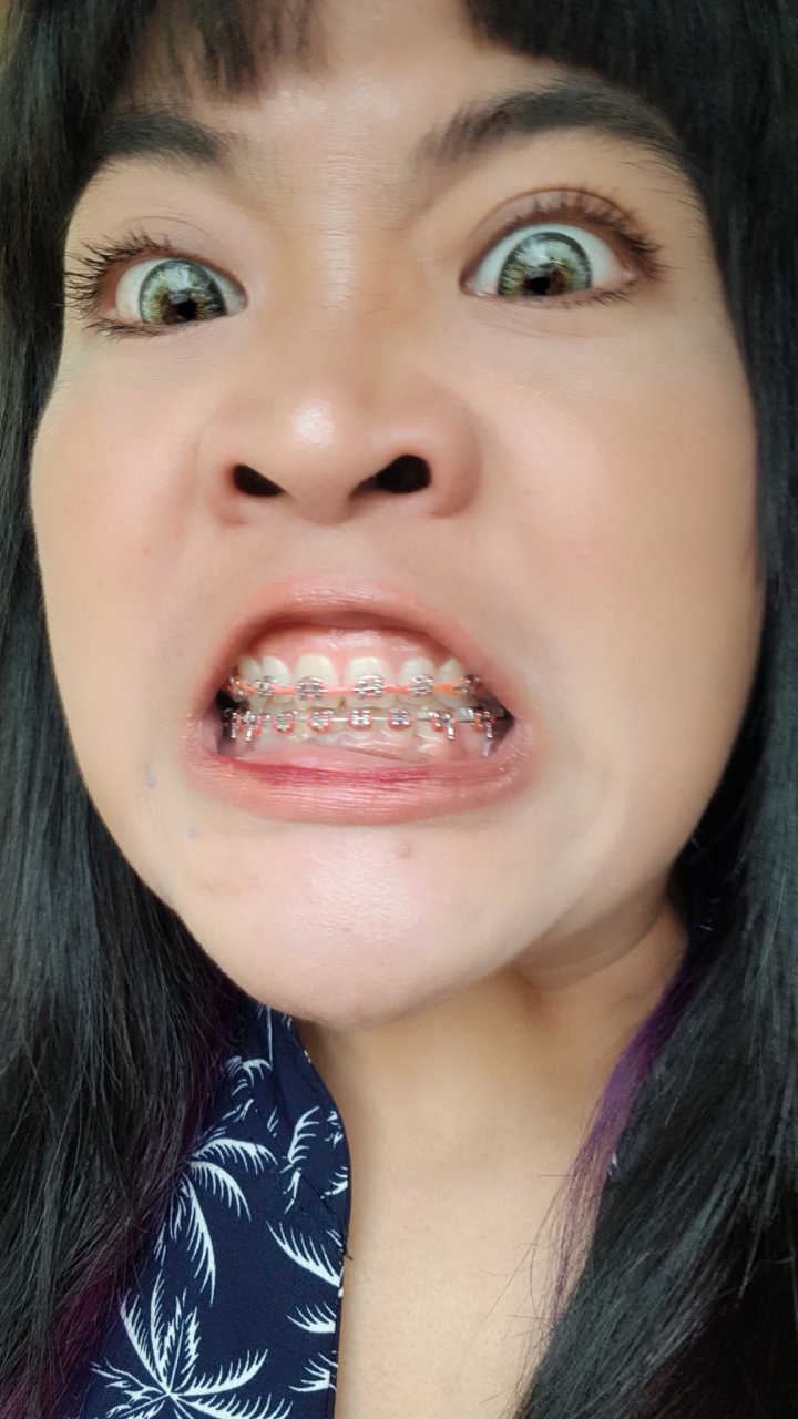 女孩子地包天矫正最好的年龄段是什么时候?