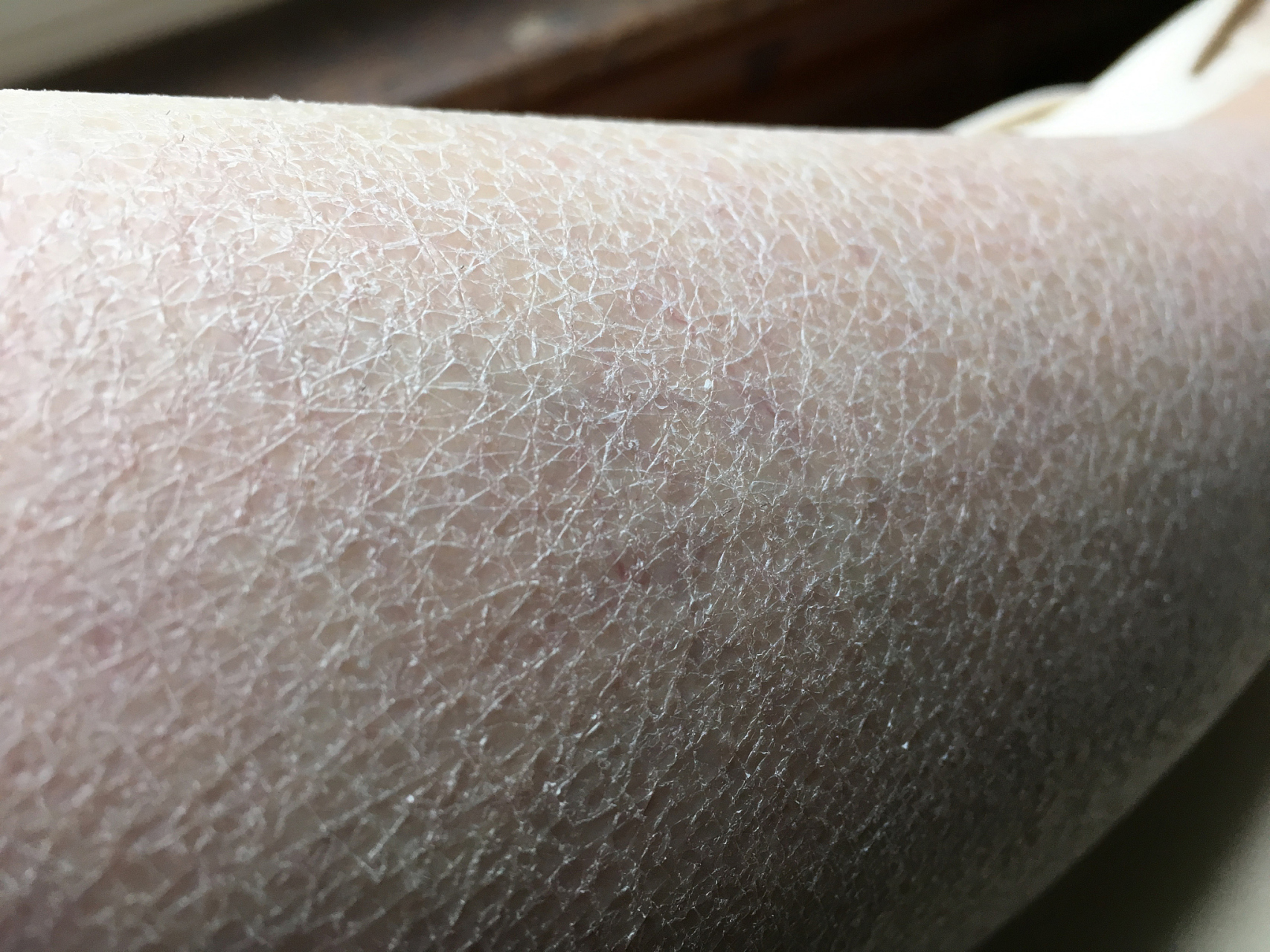 小腿起蛇皮,是一种皮肤疾病,也被称为鱼鳞病.