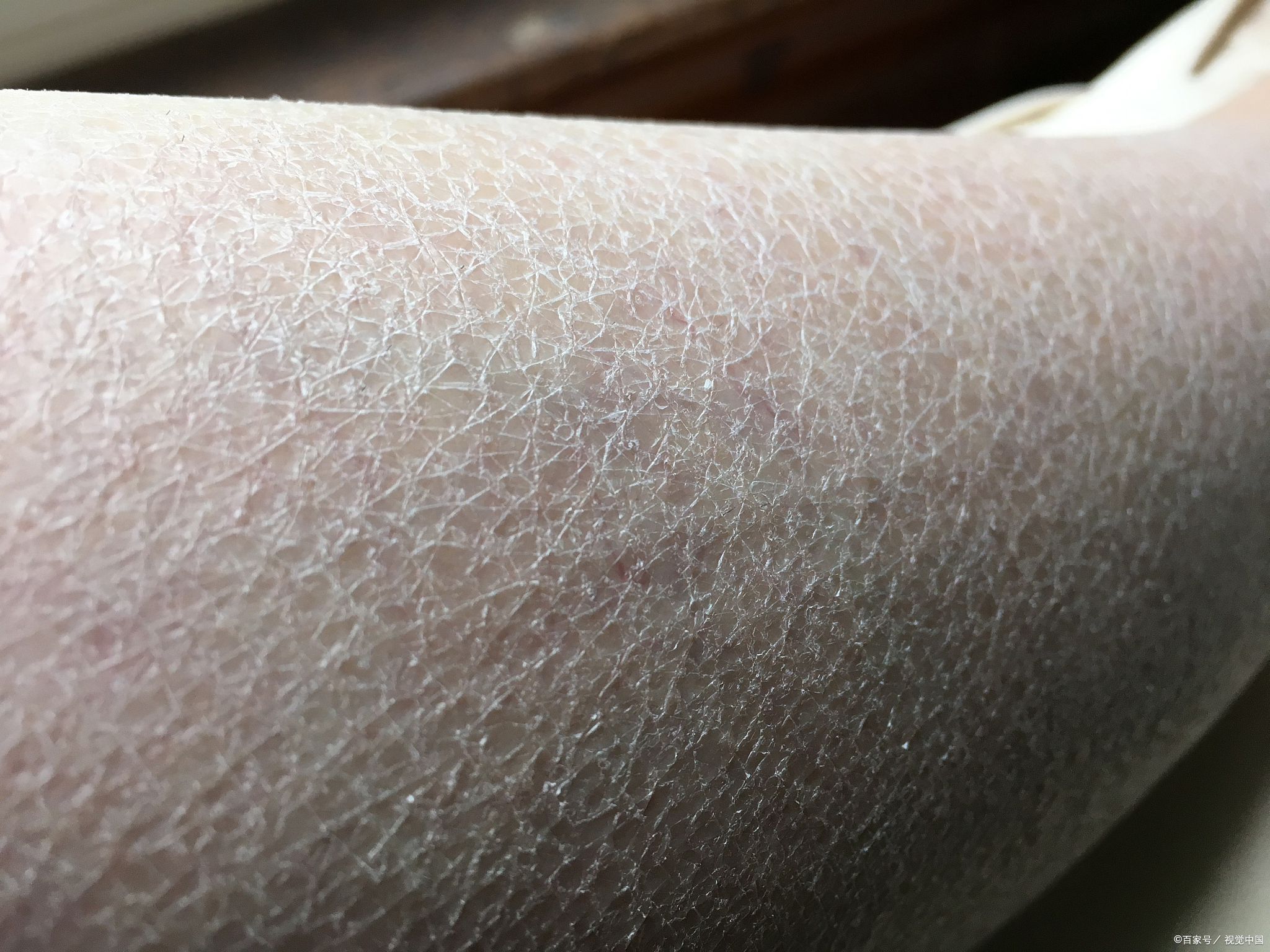 皮肤干燥# #鱼鳞皮肤病# #蛇皮腿是怎么一回事#   它是一种常见的