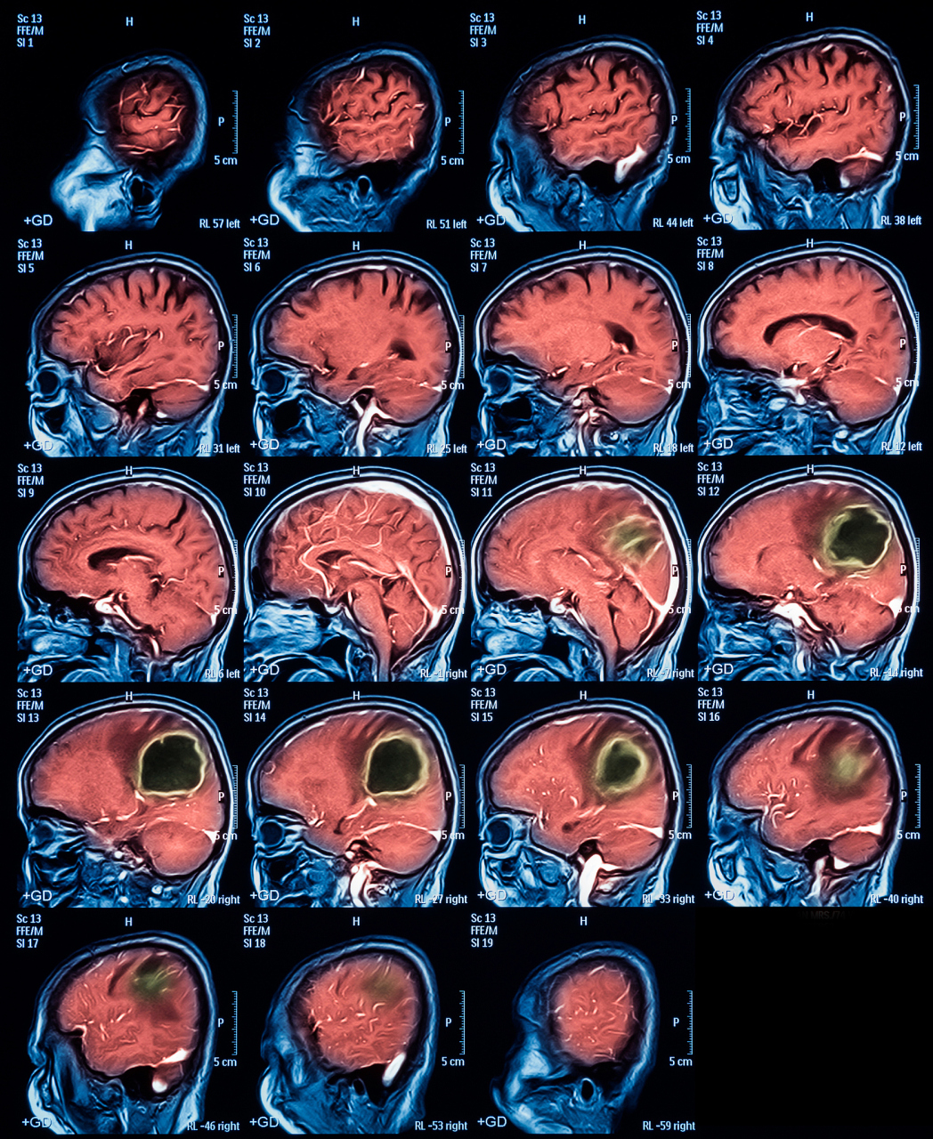 头ct显示腔隙性脑梗塞,我该怎么办?别担心,专家教你应对!